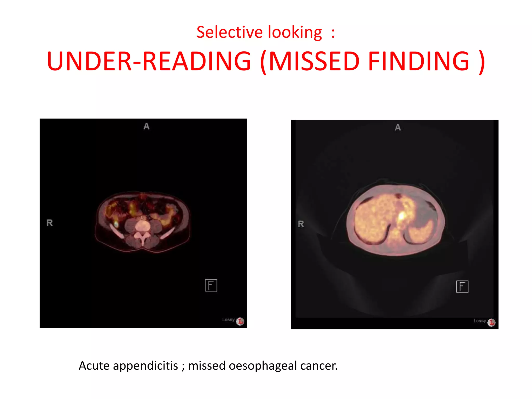 Selective looking :
UNDER-READING (MISSED FINDING )
Acute appendicitis ; missed oesophageal cancer.
 