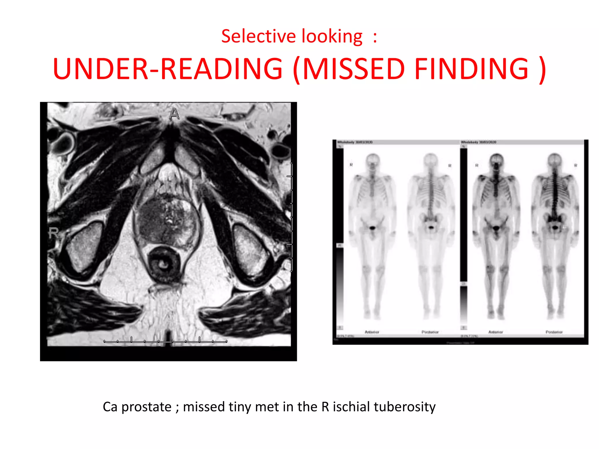 Selective looking :
UNDER-READING (MISSED FINDING )
Ca prostate ; missed tiny met in the R ischial tuberosity
 