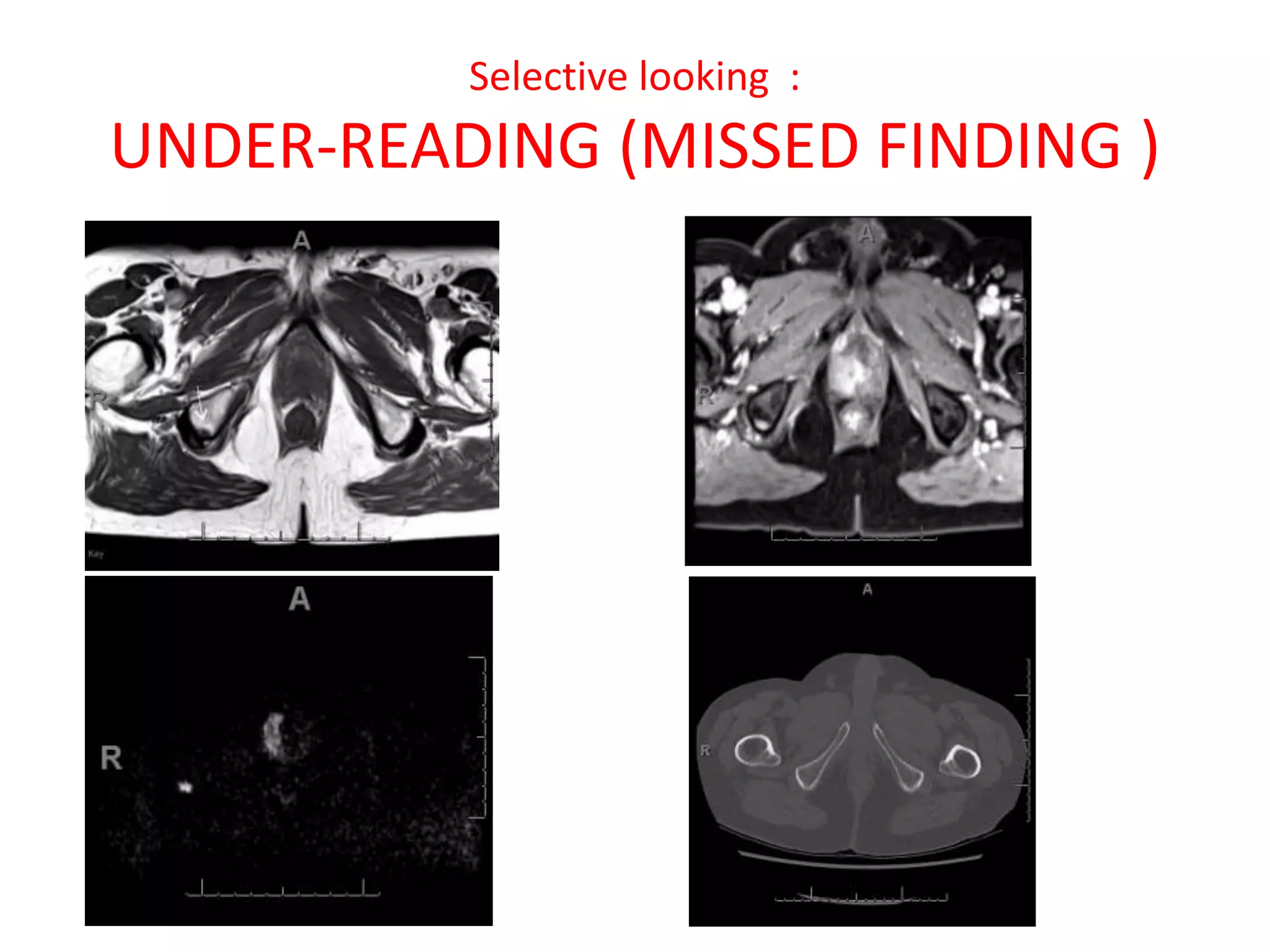 Selective looking :
UNDER-READING (MISSED FINDING )
 