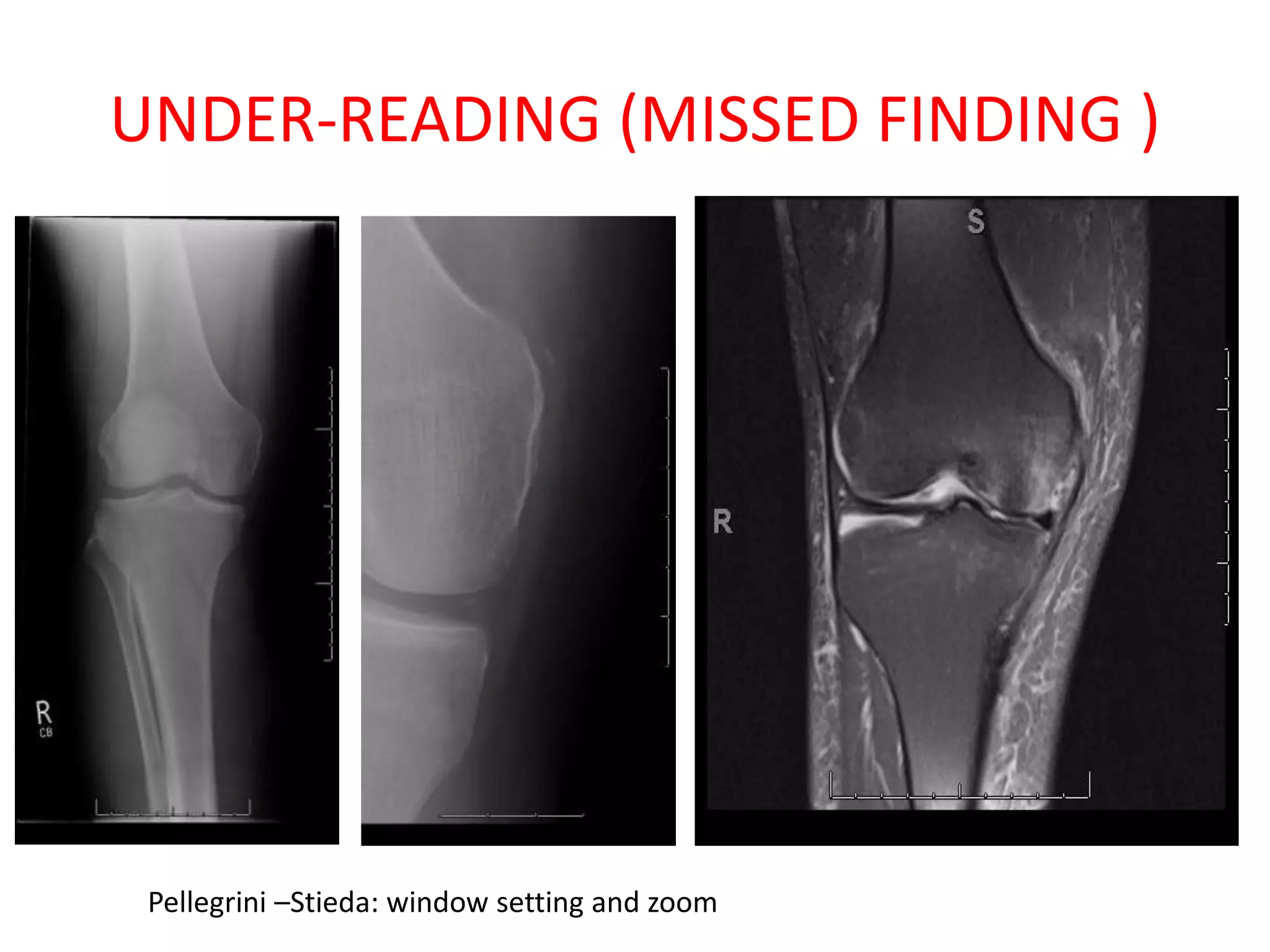 UNDER-READING (MISSED FINDING )
Pellegrini –Stieda: window setting and zoom
 