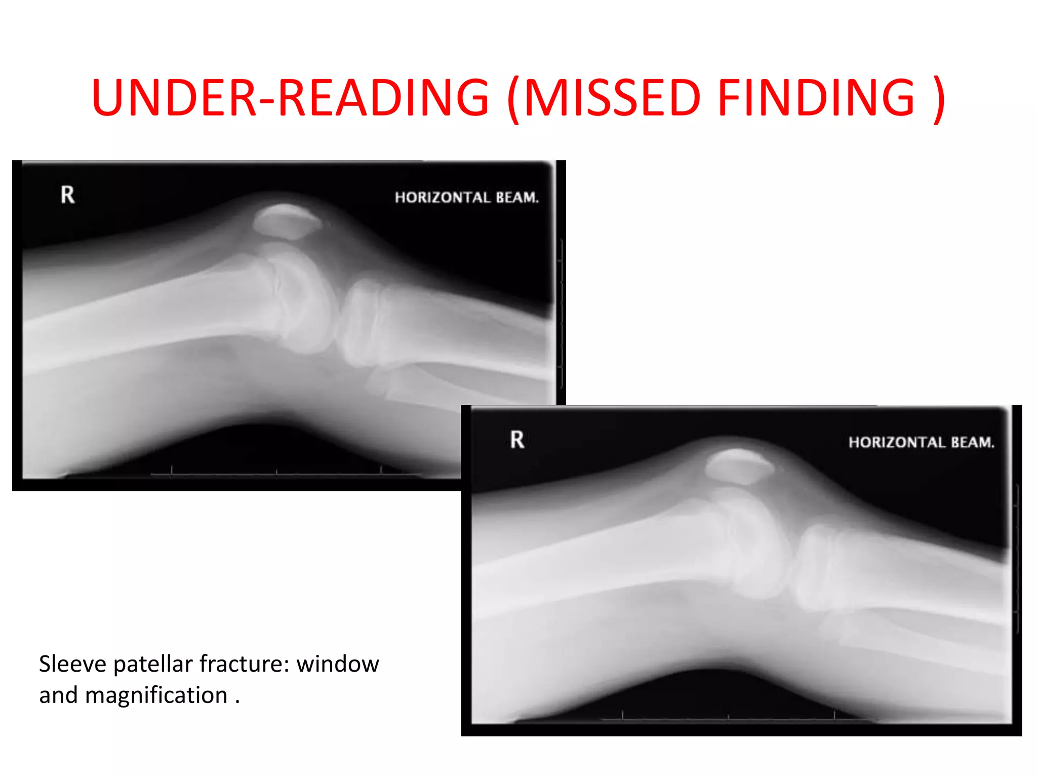 UNDER-READING (MISSED FINDING )
Sleeve patellar fracture: window
and magnification .
 
