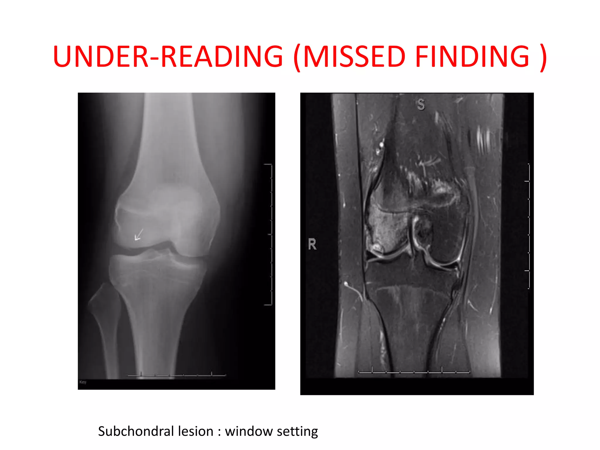 UNDER-READING (MISSED FINDING )
Subchondral lesion : window setting
 