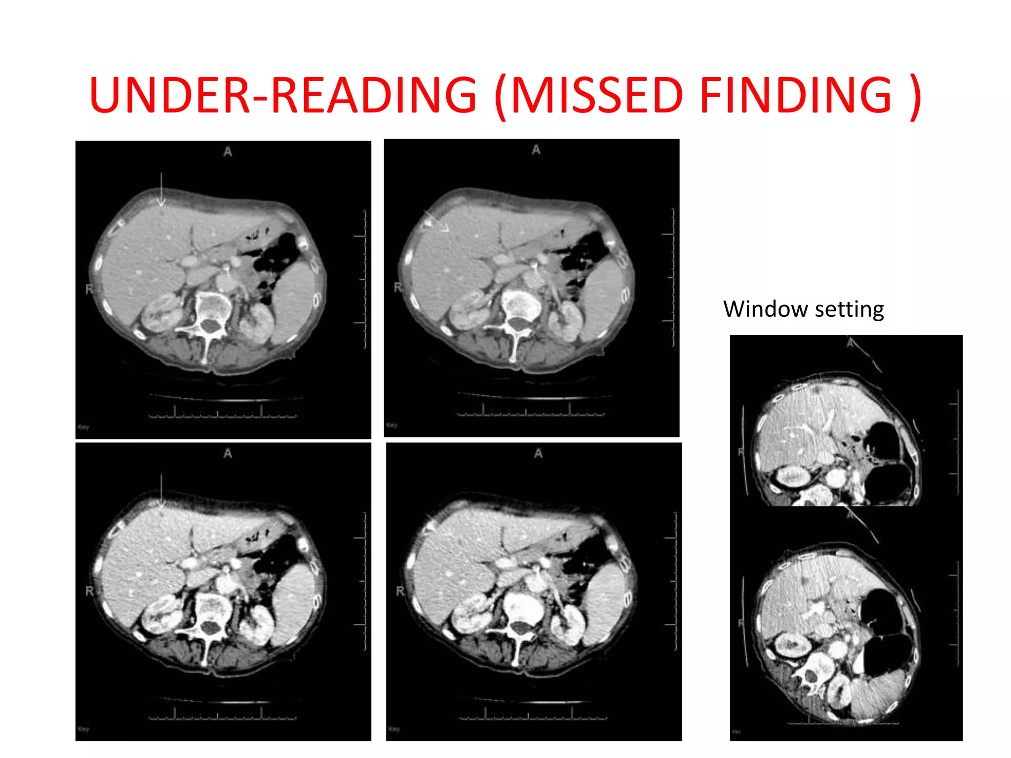 UNDER-READING (MISSED FINDING )
Window setting
 