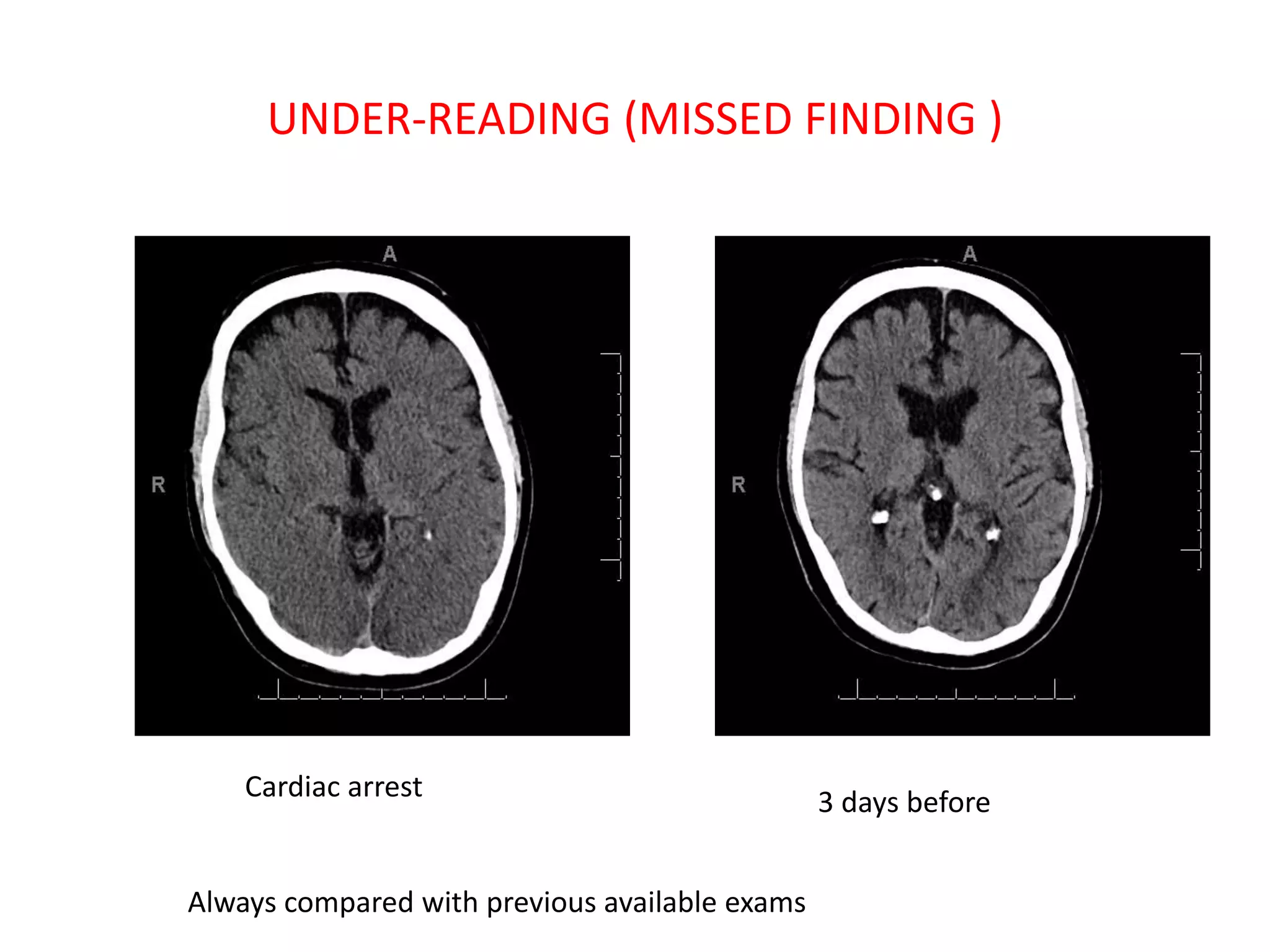 UNDER-READING (MISSED FINDING )
3 days before
Cardiac arrest
Always compared with previous available exams
 