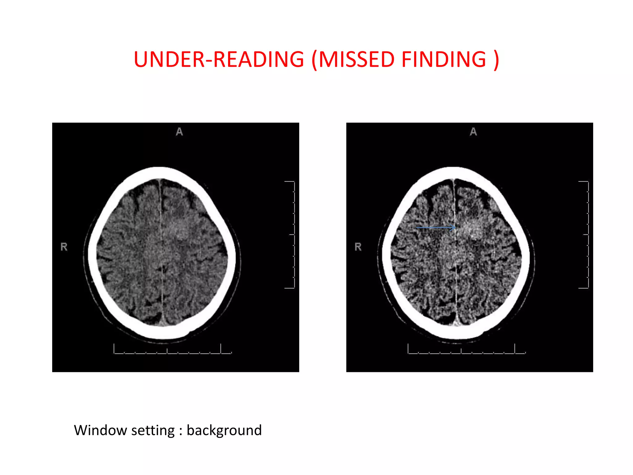 UNDER-READING (MISSED FINDING )
Window setting : background
 