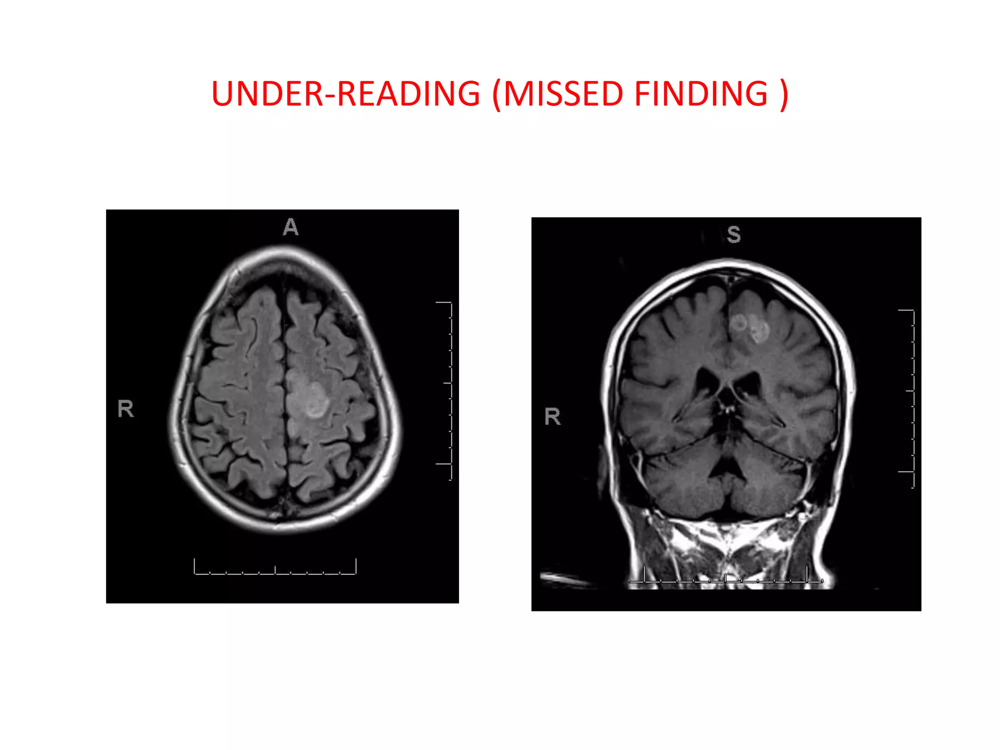 UNDER-READING (MISSED FINDING )
 