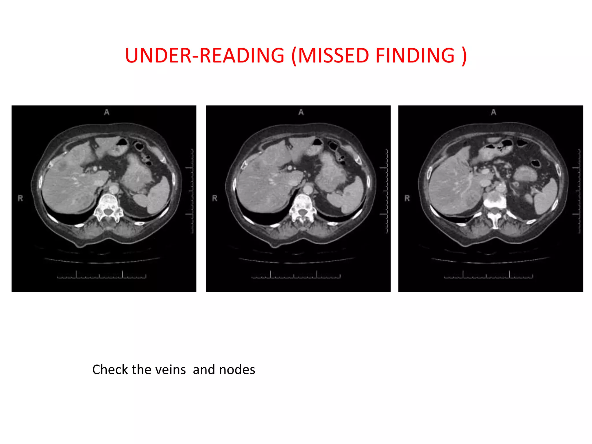 UNDER-READING (MISSED FINDING )
Check the veins and nodes
 