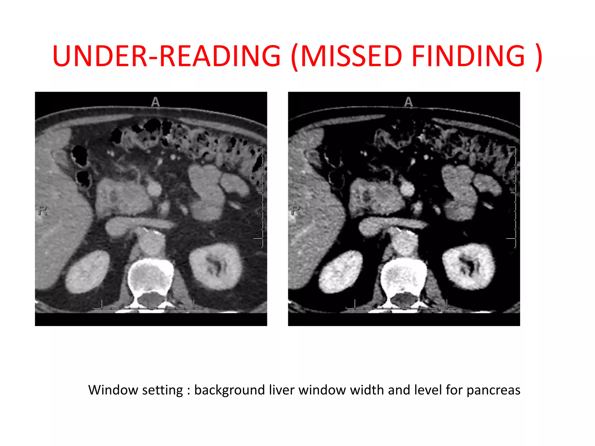UNDER-READING (MISSED FINDING )
Window setting : background liver window width and level for pancreas
 