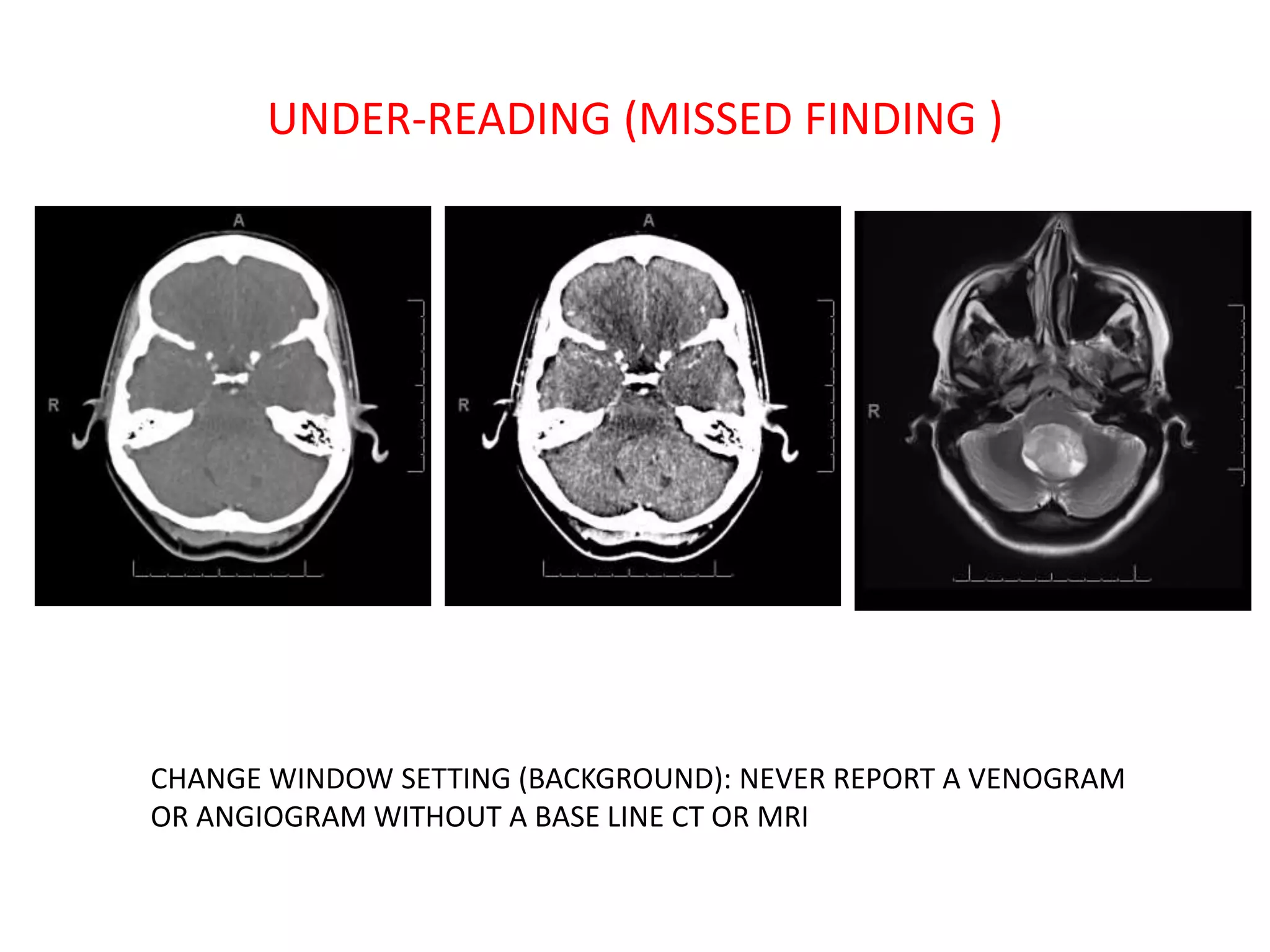UNDER-READING (MISSED FINDING )
CHANGE WINDOW SETTING (BACKGROUND): NEVER REPORT A VENOGRAM
OR ANGIOGRAM WITHOUT A BASE LINE CT OR MRI
 