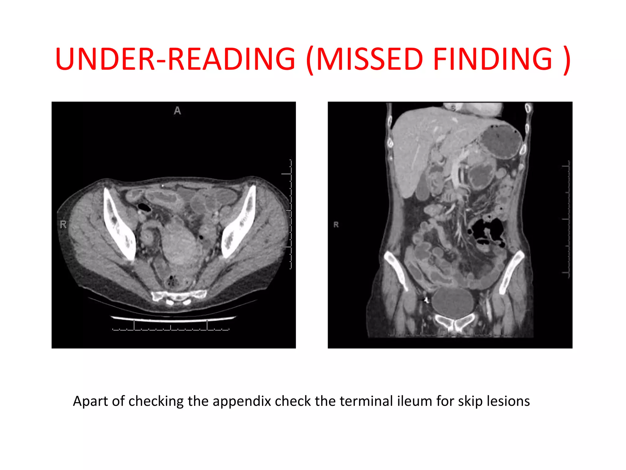 UNDER-READING (MISSED FINDING )
Apart of checking the appendix check the terminal ileum for skip lesions
 