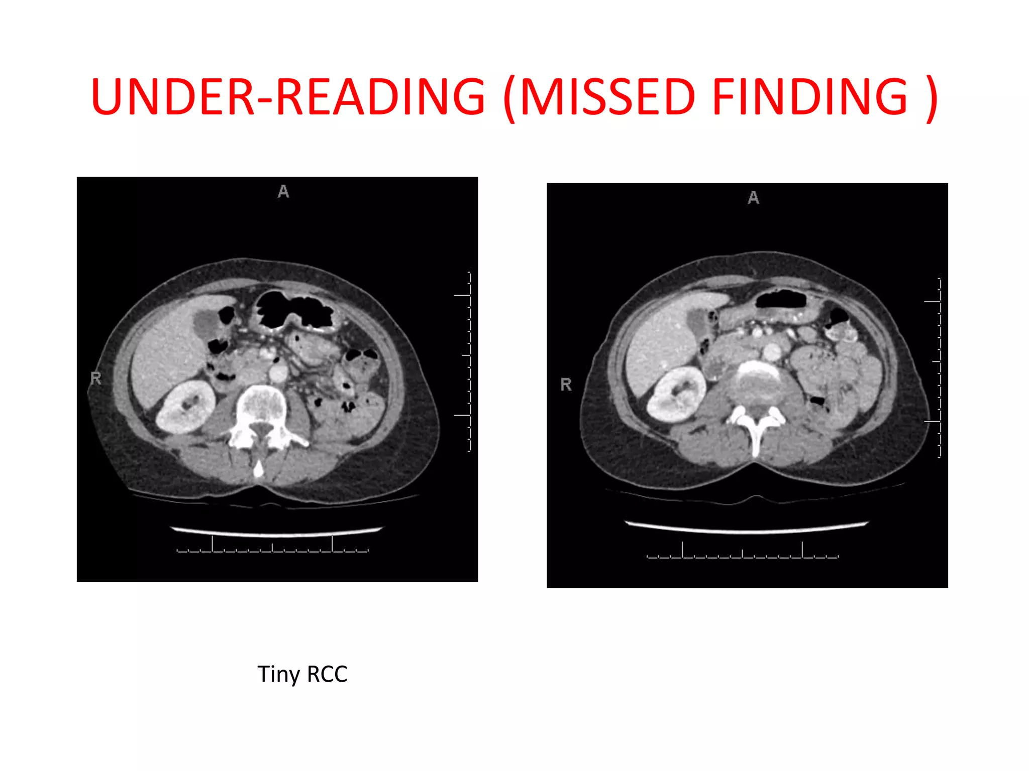 UNDER-READING (MISSED FINDING )
Tiny RCC
 