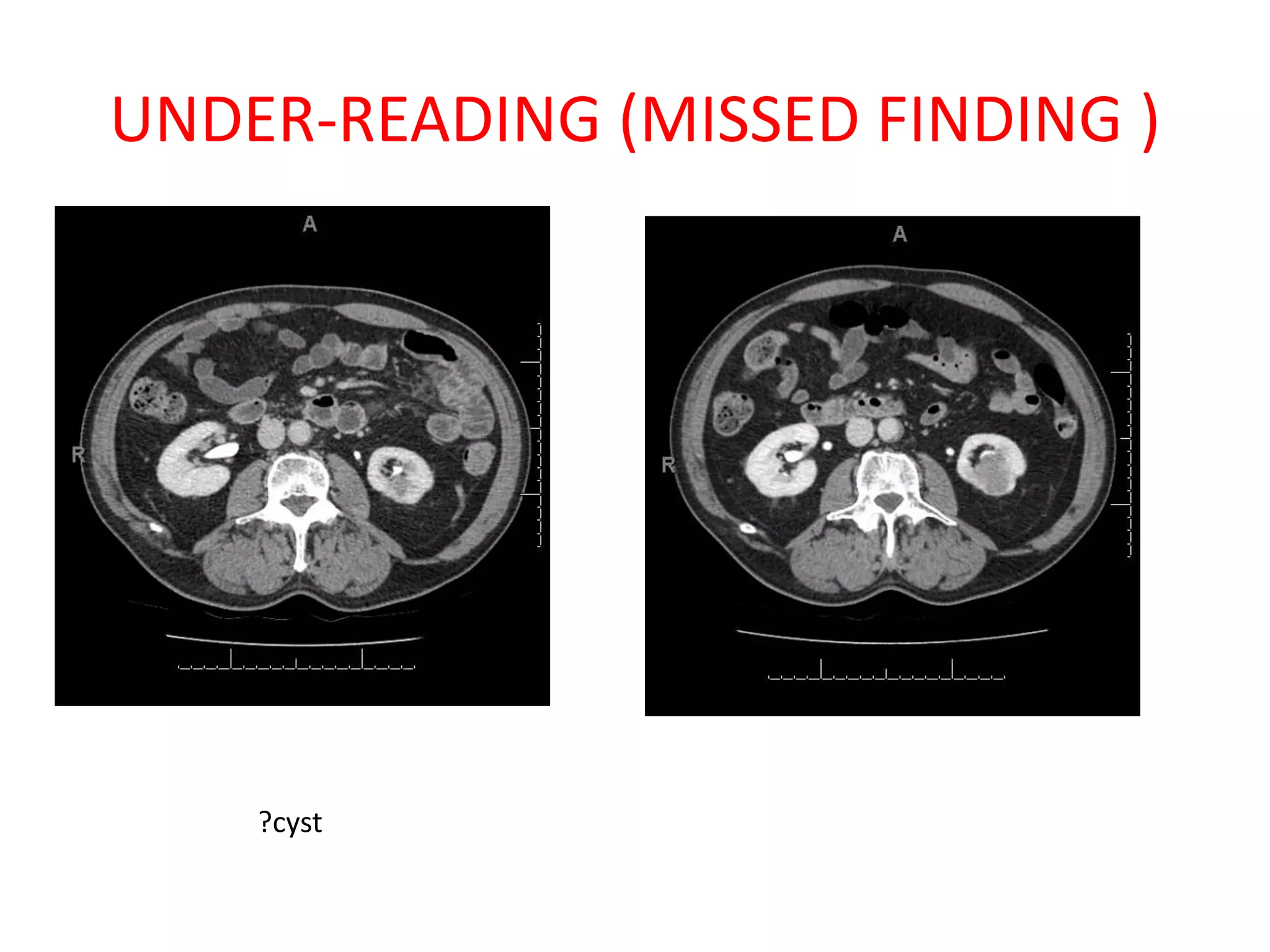 UNDER-READING (MISSED FINDING )
?cyst
 