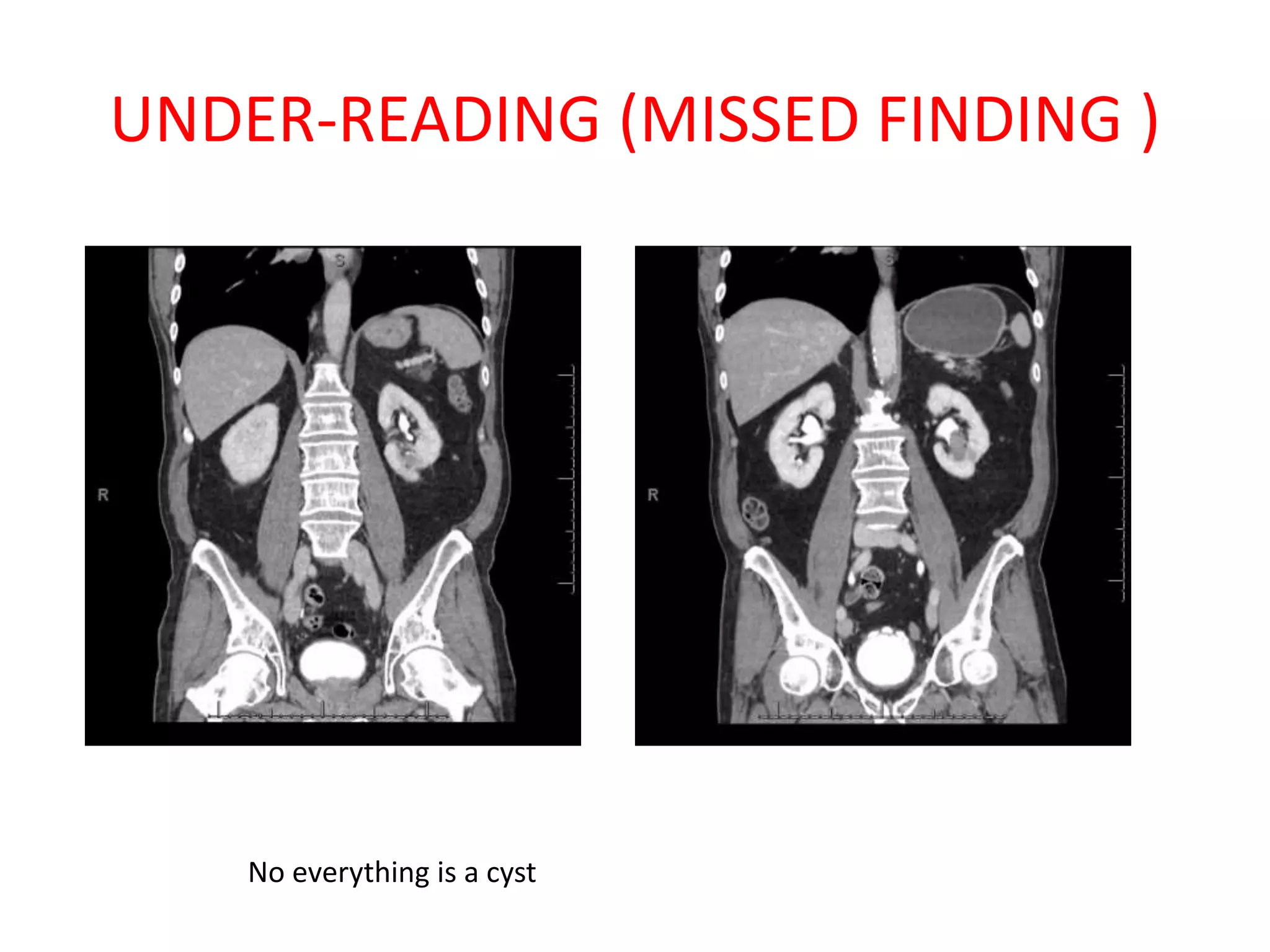 UNDER-READING (MISSED FINDING )
No everything is a cyst
 
