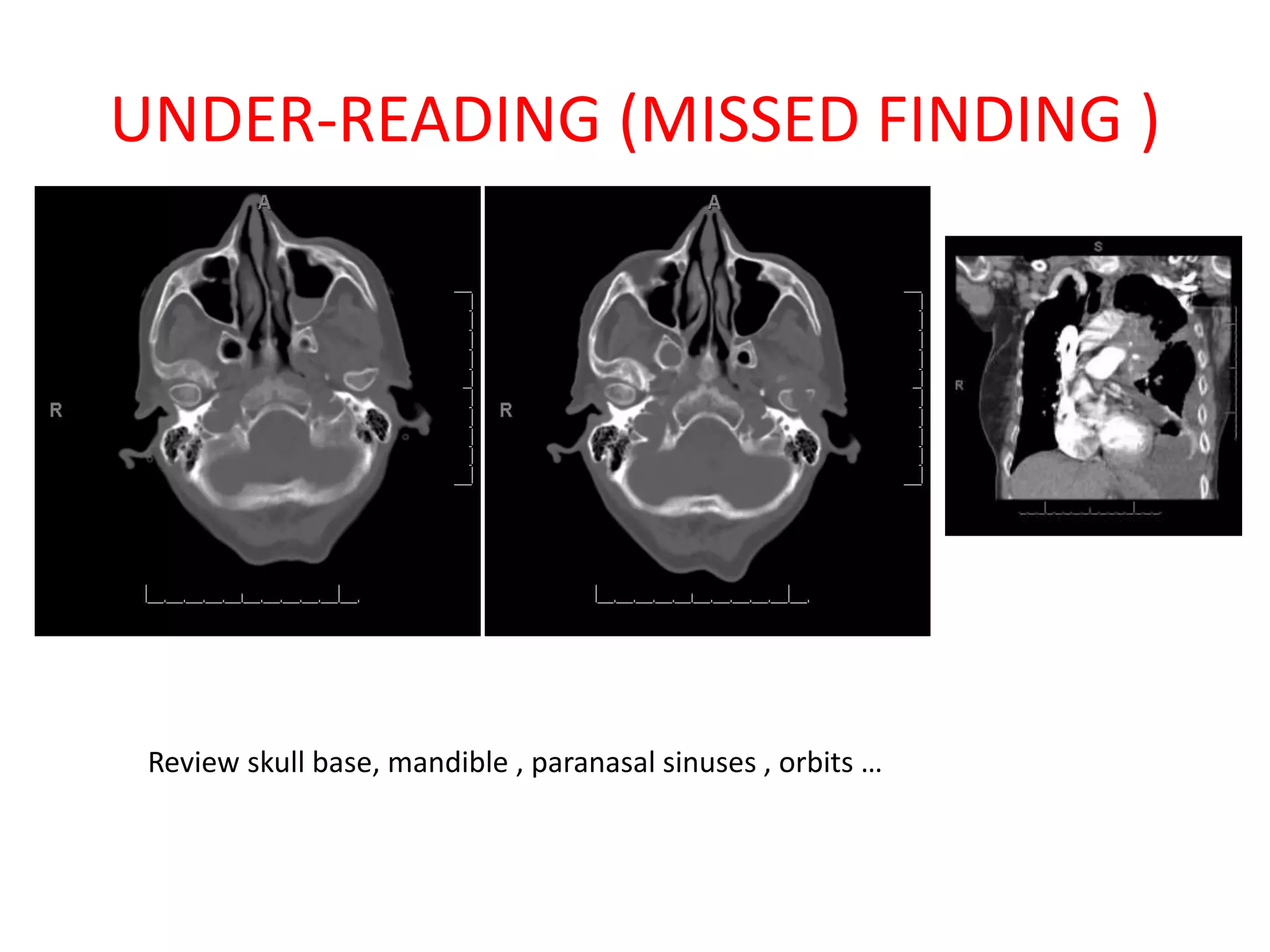 UNDER-READING (MISSED FINDING )
Review skull base, mandible , paranasal sinuses , orbits …
 