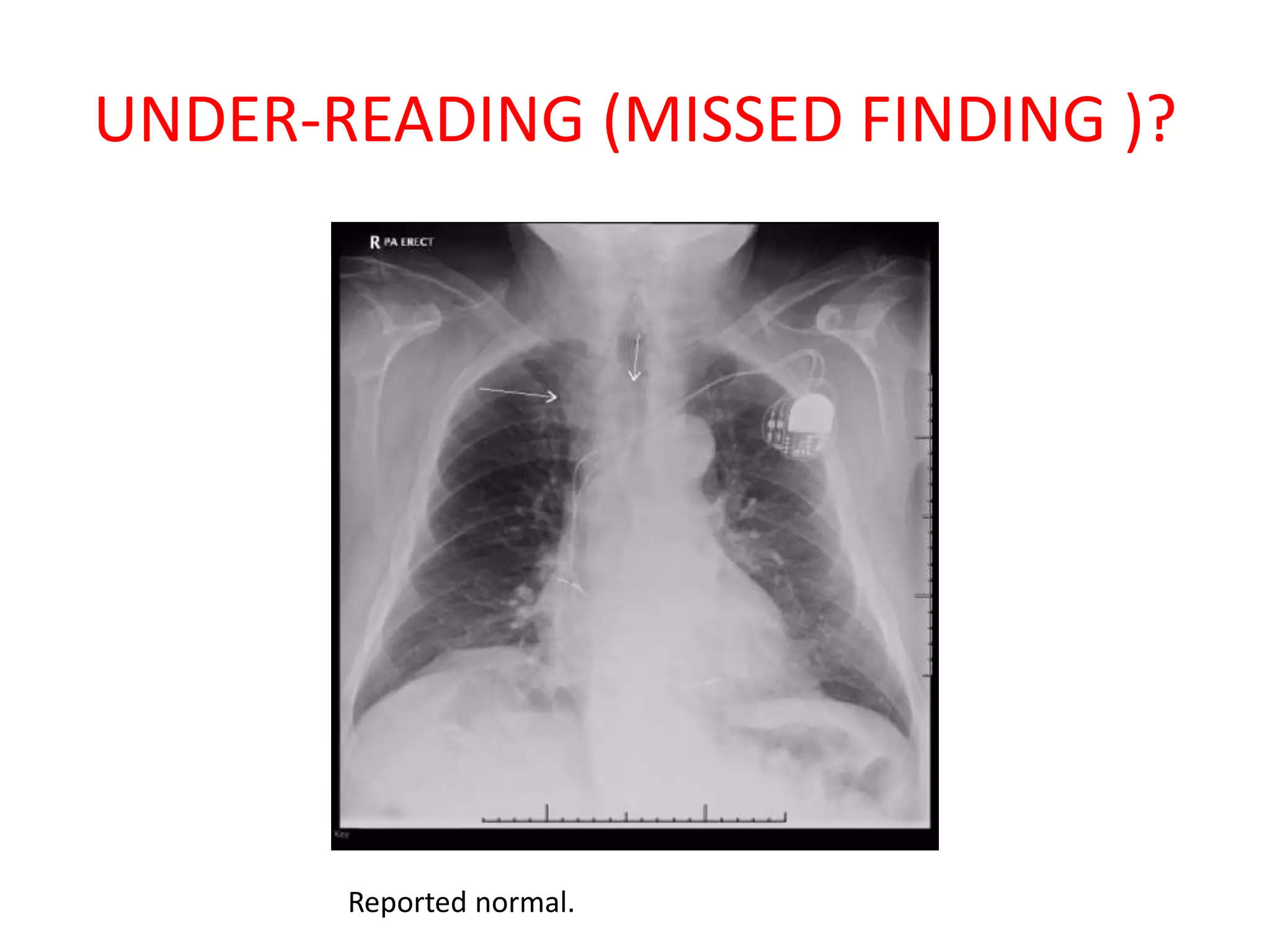 UNDER-READING (MISSED FINDING )?
Reported normal.
 