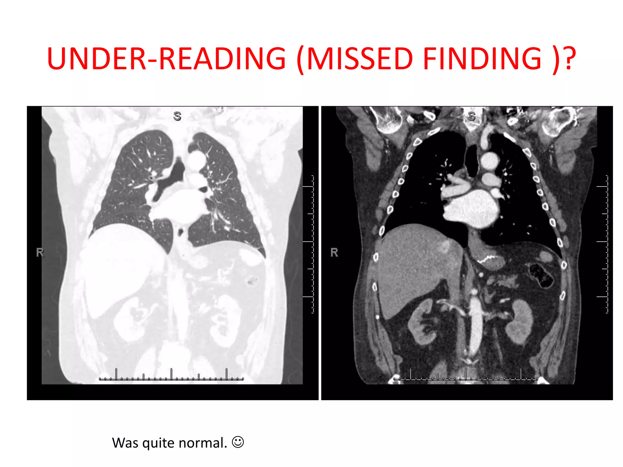 UNDER-READING (MISSED FINDING )?
Was quite normal. 
 