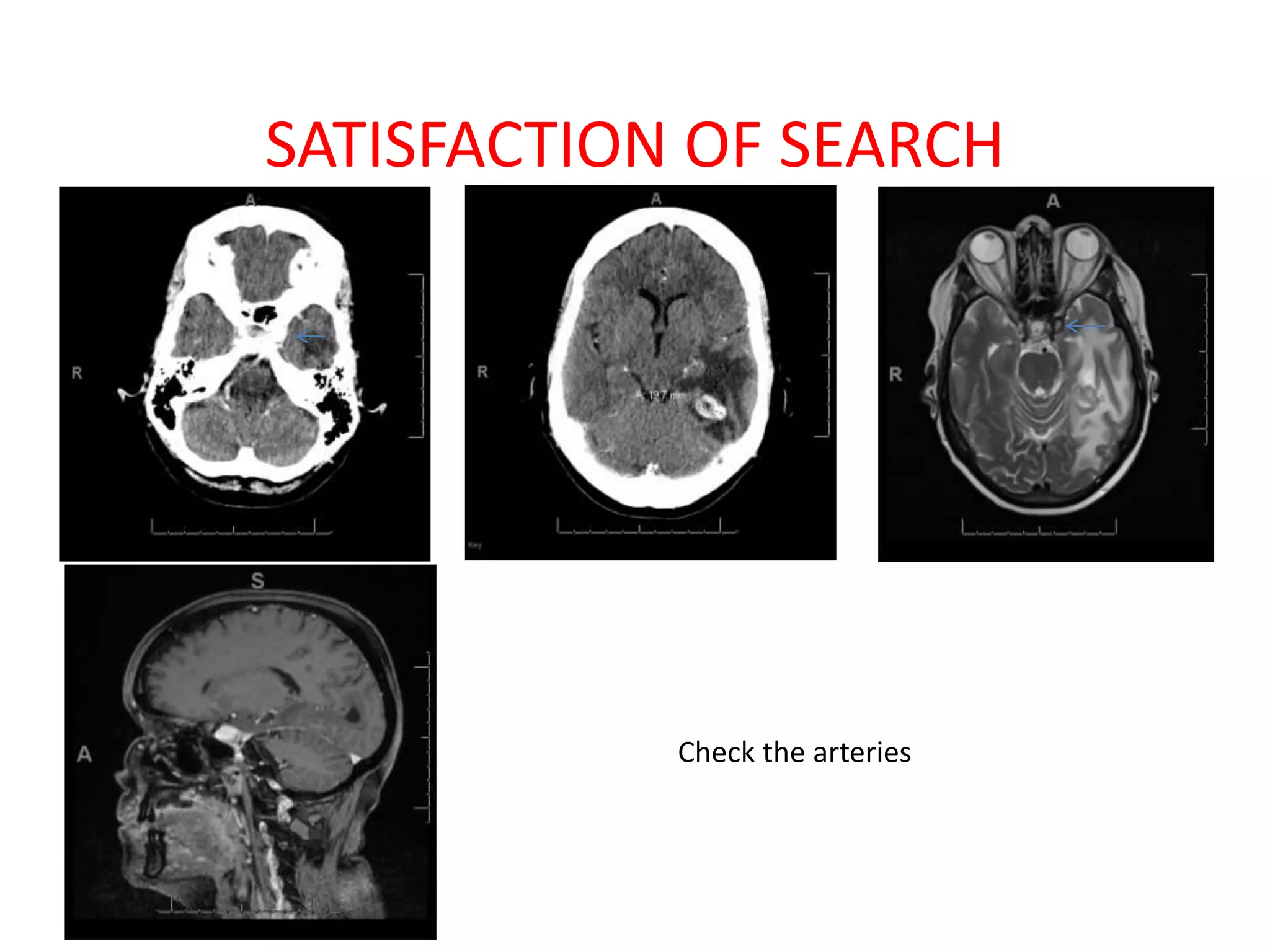 SATISFACTION OF SEARCH
Check the arteries
 