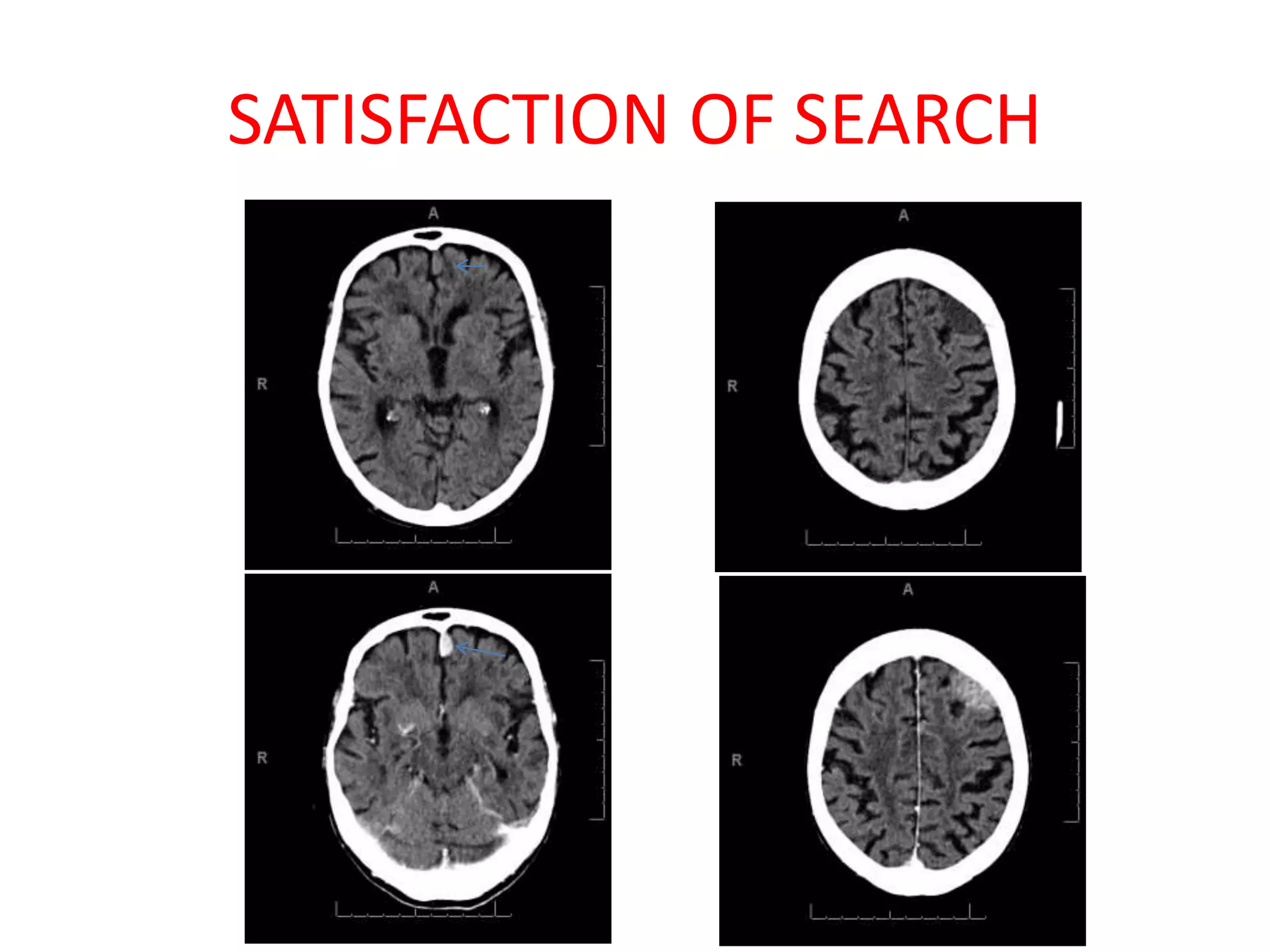 SATISFACTION OF SEARCH
 