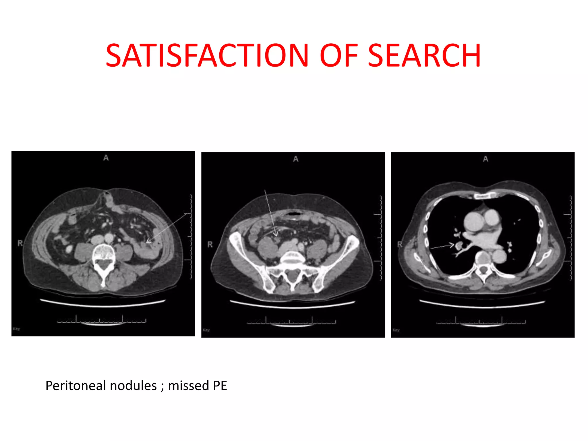 SATISFACTION OF SEARCH
Peritoneal nodules ; missed PE
 