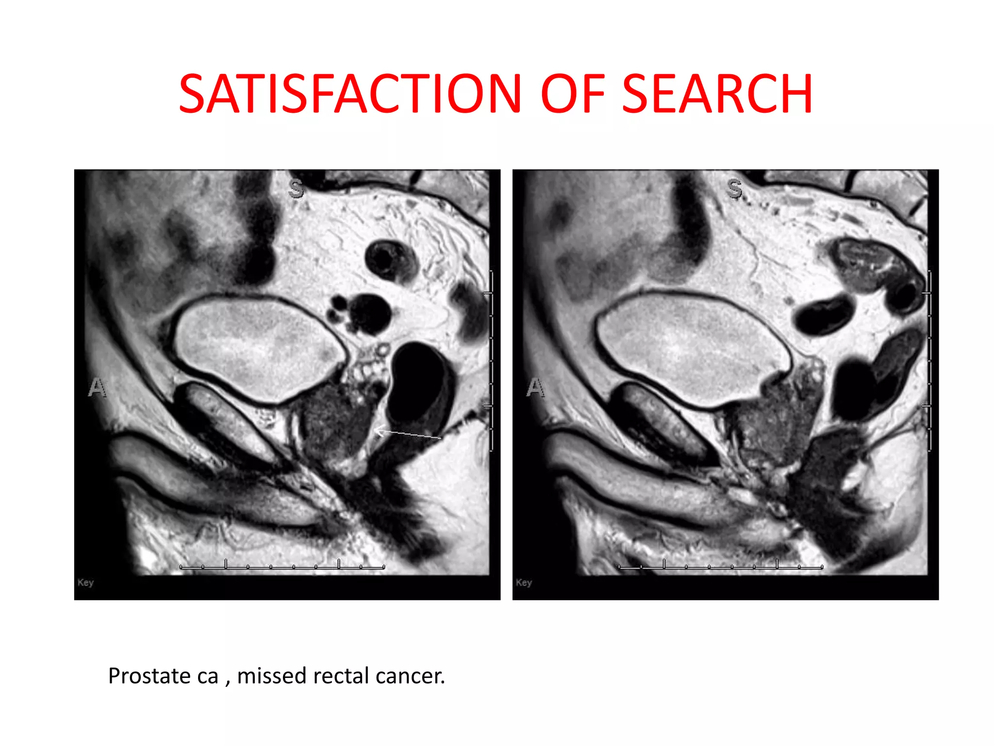 SATISFACTION OF SEARCH
Prostate ca , missed rectal cancer.
 