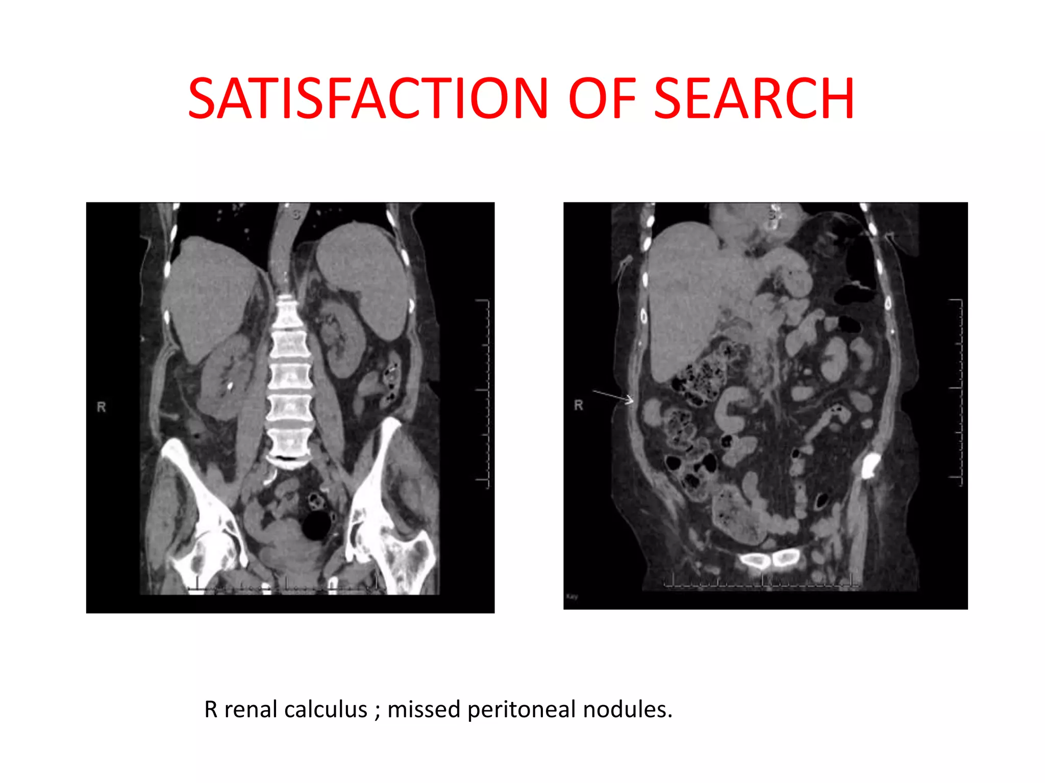 SATISFACTION OF SEARCH
R renal calculus ; missed peritoneal nodules.
 