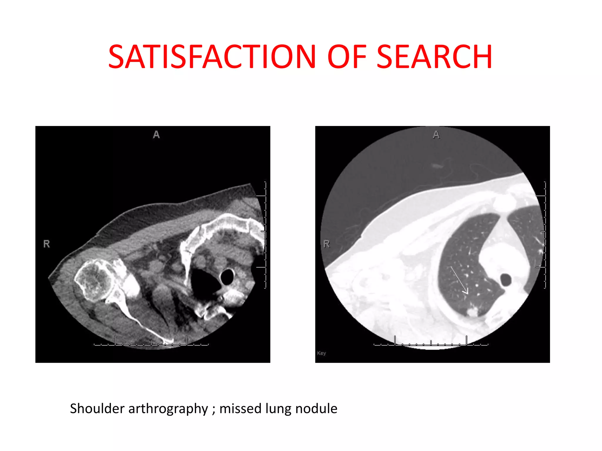 SATISFACTION OF SEARCH
Shoulder arthrography ; missed lung nodule
 