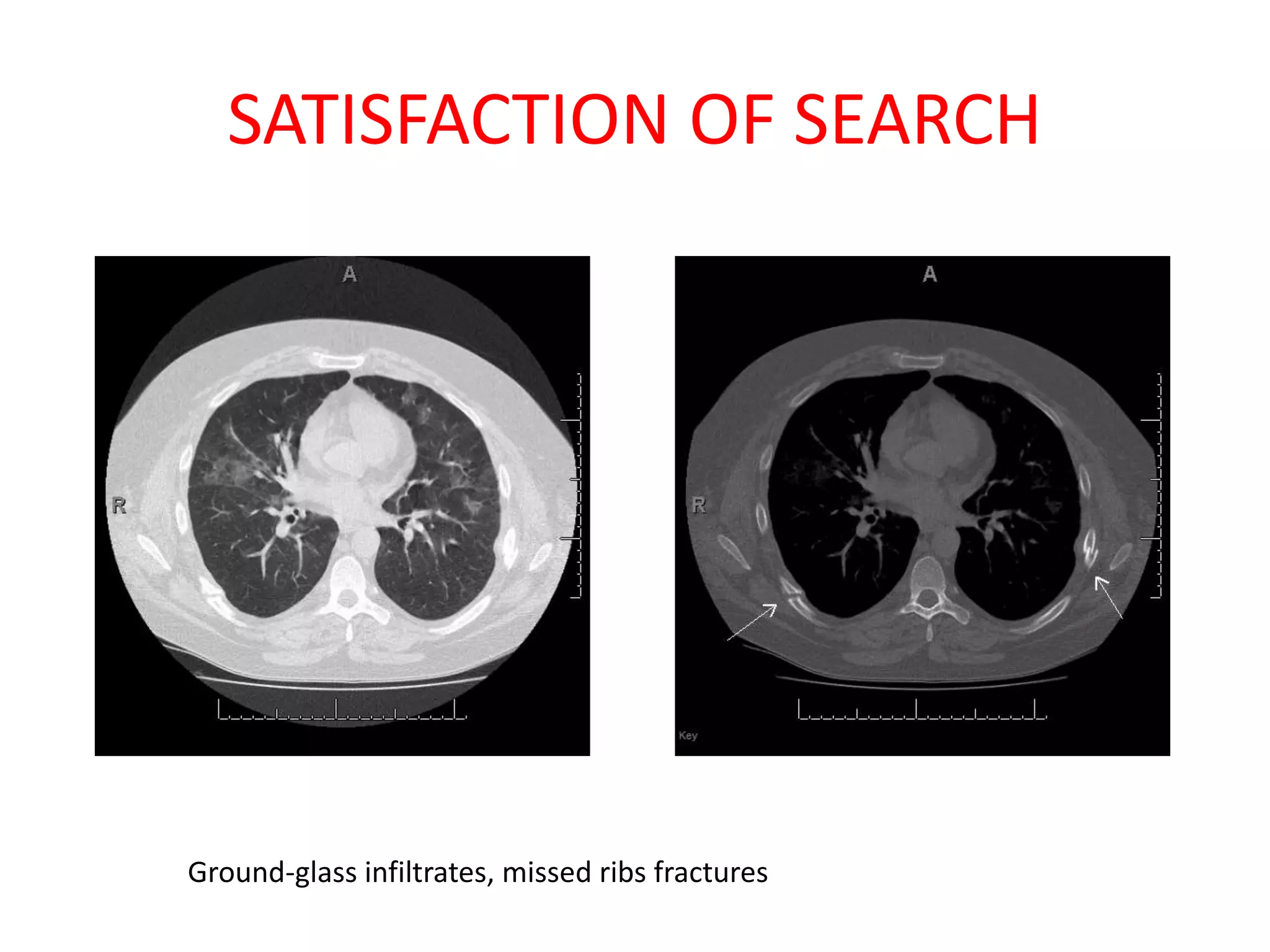 SATISFACTION OF SEARCH
Ground-glass infiltrates, missed ribs fractures
 