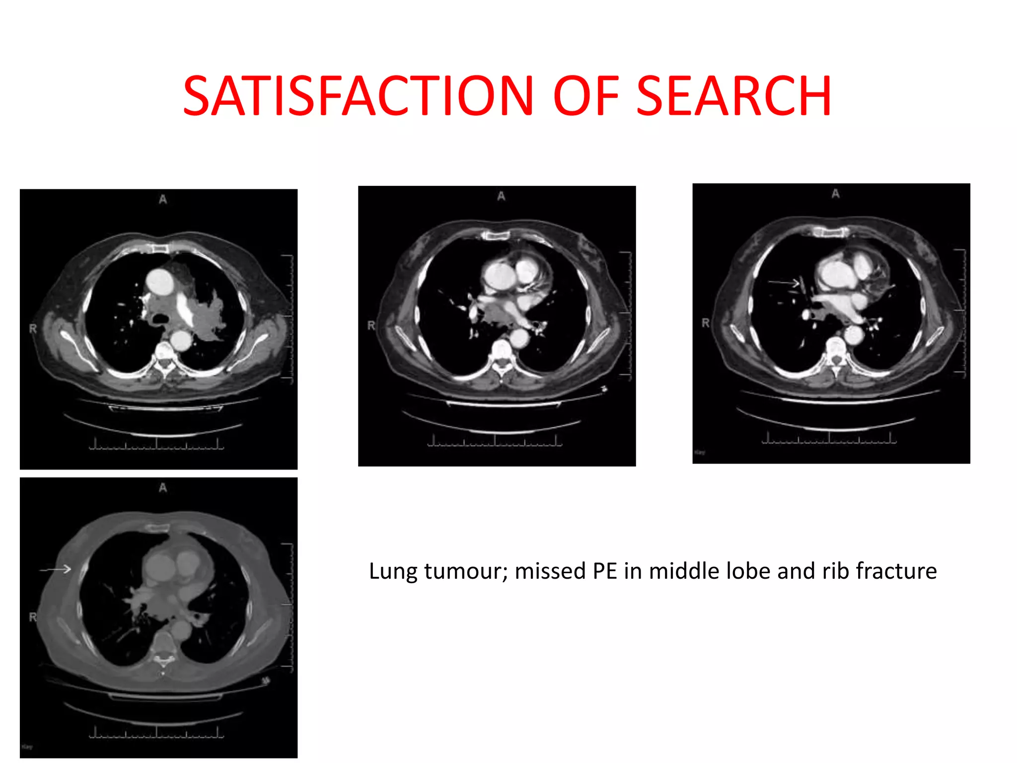 SATISFACTION OF SEARCH
Lung tumour; missed PE in middle lobe and rib fracture
 