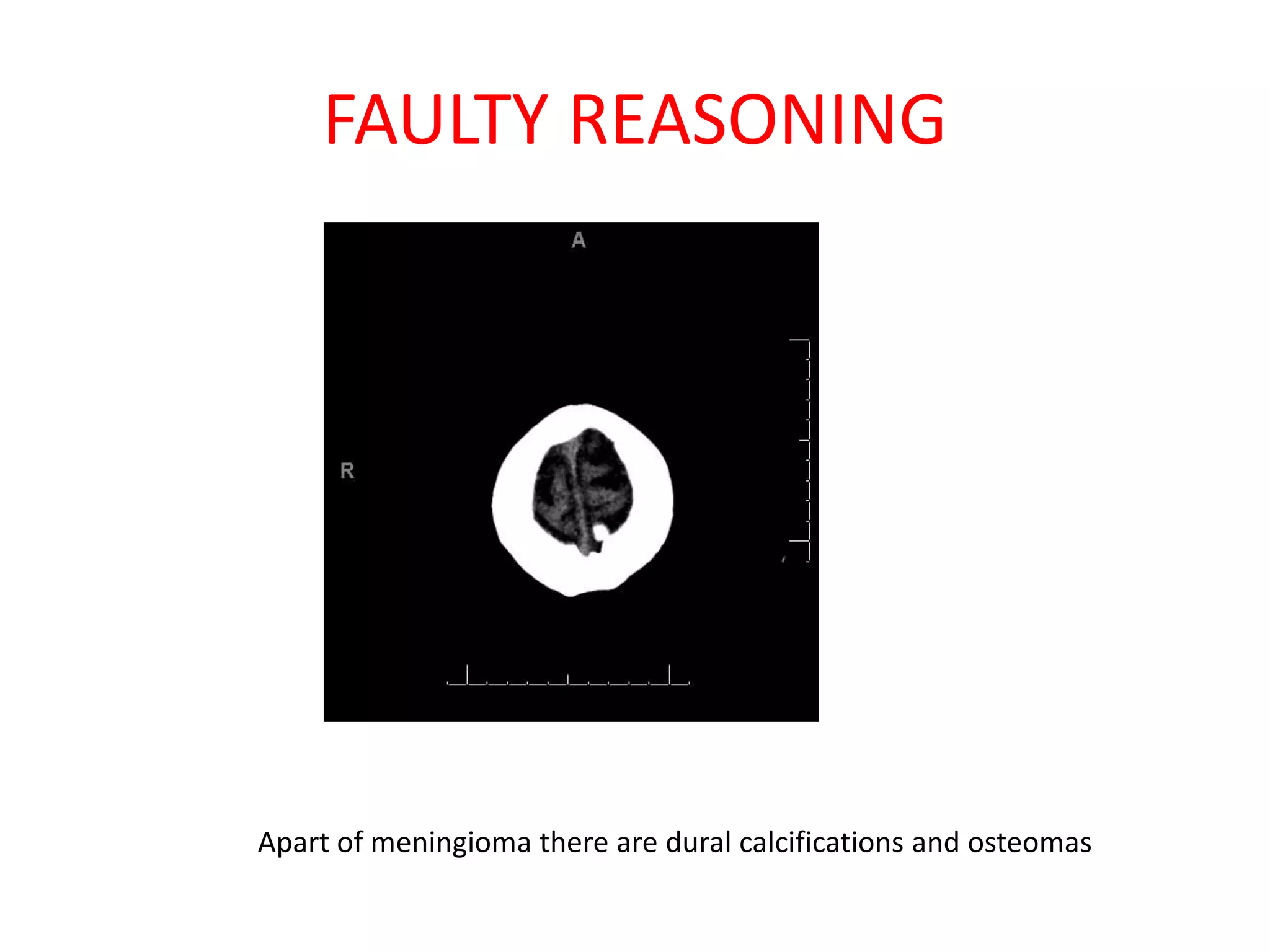 FAULTY REASONING
Apart of meningioma there are dural calcifications and osteomas
 