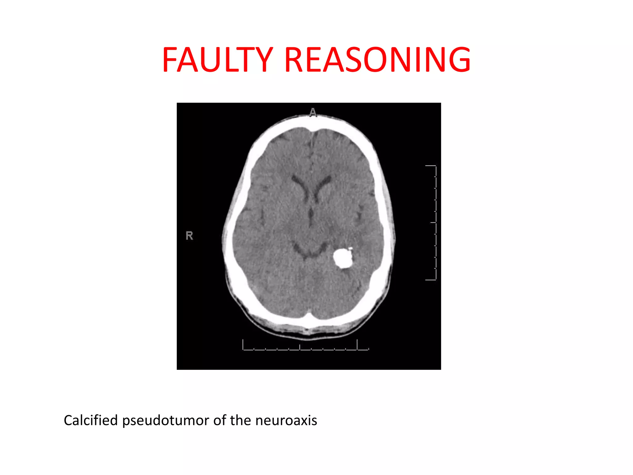 FAULTY REASONING
Calcified pseudotumor of the neuroaxis
 