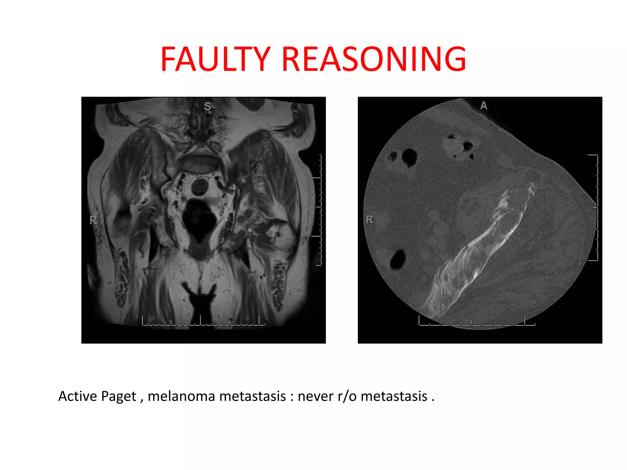 FAULTY REASONING
Active Paget , melanoma metastasis : never r/o metastasis .
 