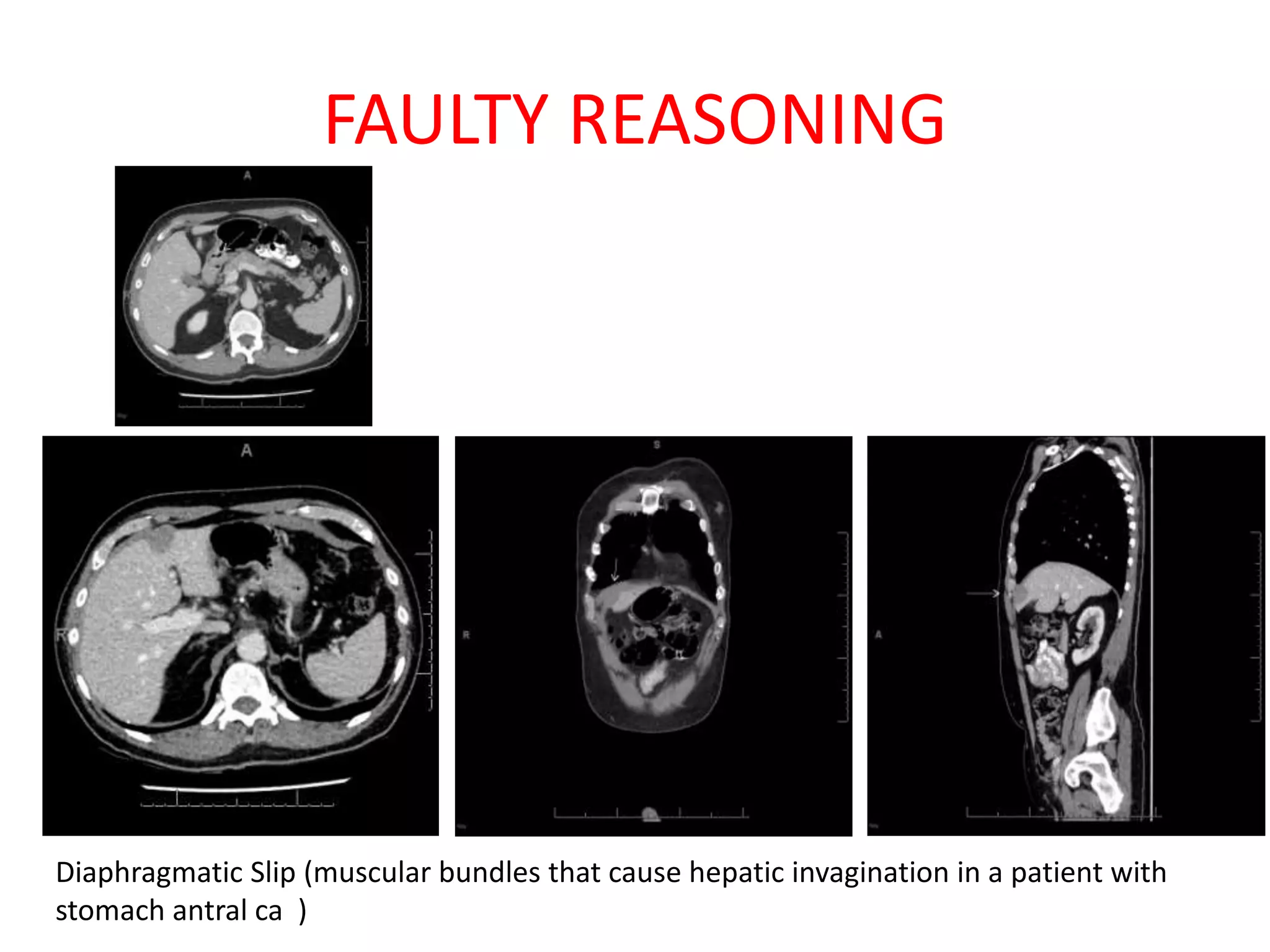 FAULTY REASONING
Diaphragmatic Slip (muscular bundles that cause hepatic invagination in a patient with
stomach antral ca )
 