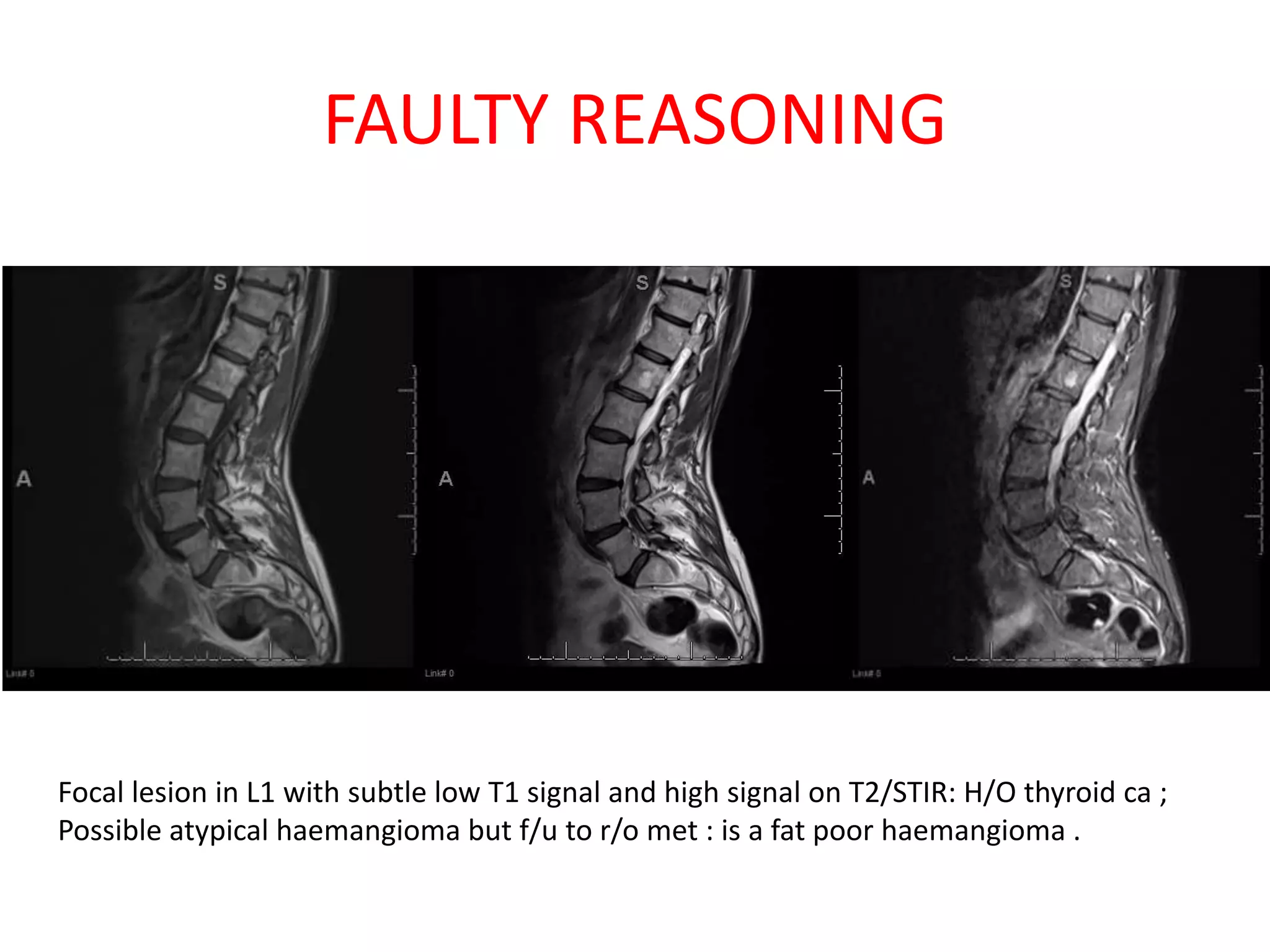 FAULTY REASONING
Focal lesion in L1 with subtle low T1 signal and high signal on T2/STIR: H/O thyroid ca ;
Possible atypical haemangioma but f/u to r/o met : is a fat poor haemangioma .
 