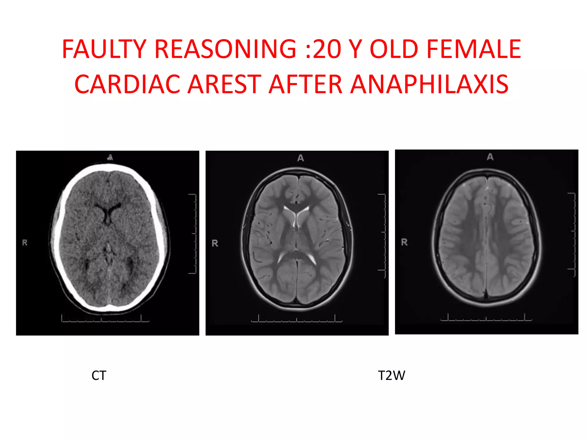 FAULTY REASONING :20 Y OLD FEMALE
CARDIAC AREST AFTER ANAPHILAXIS
CT T2W
 