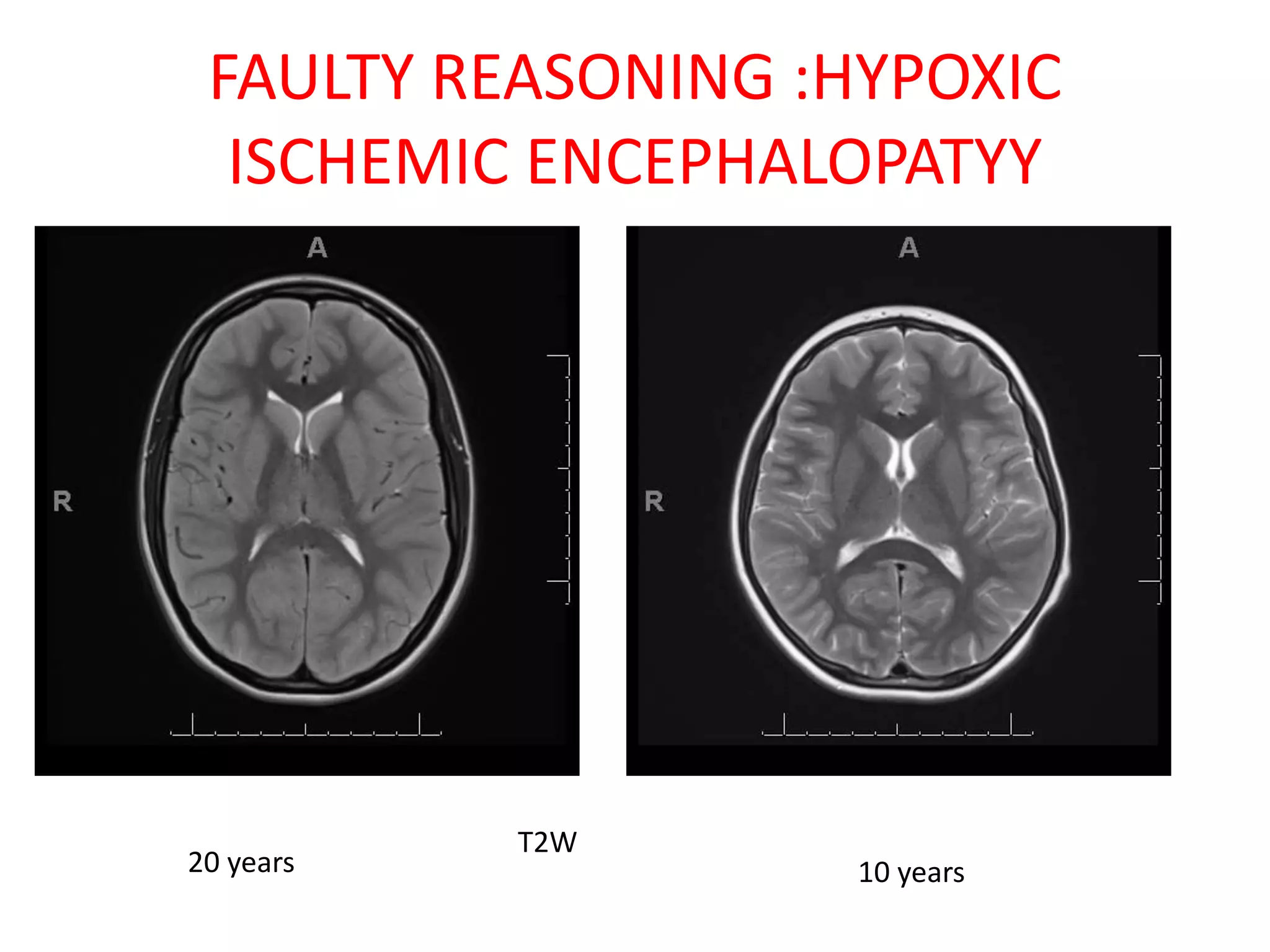FAULTY REASONING :HYPOXIC
ISCHEMIC ENCEPHALOPATYY
20 years 10 years
T2W
 