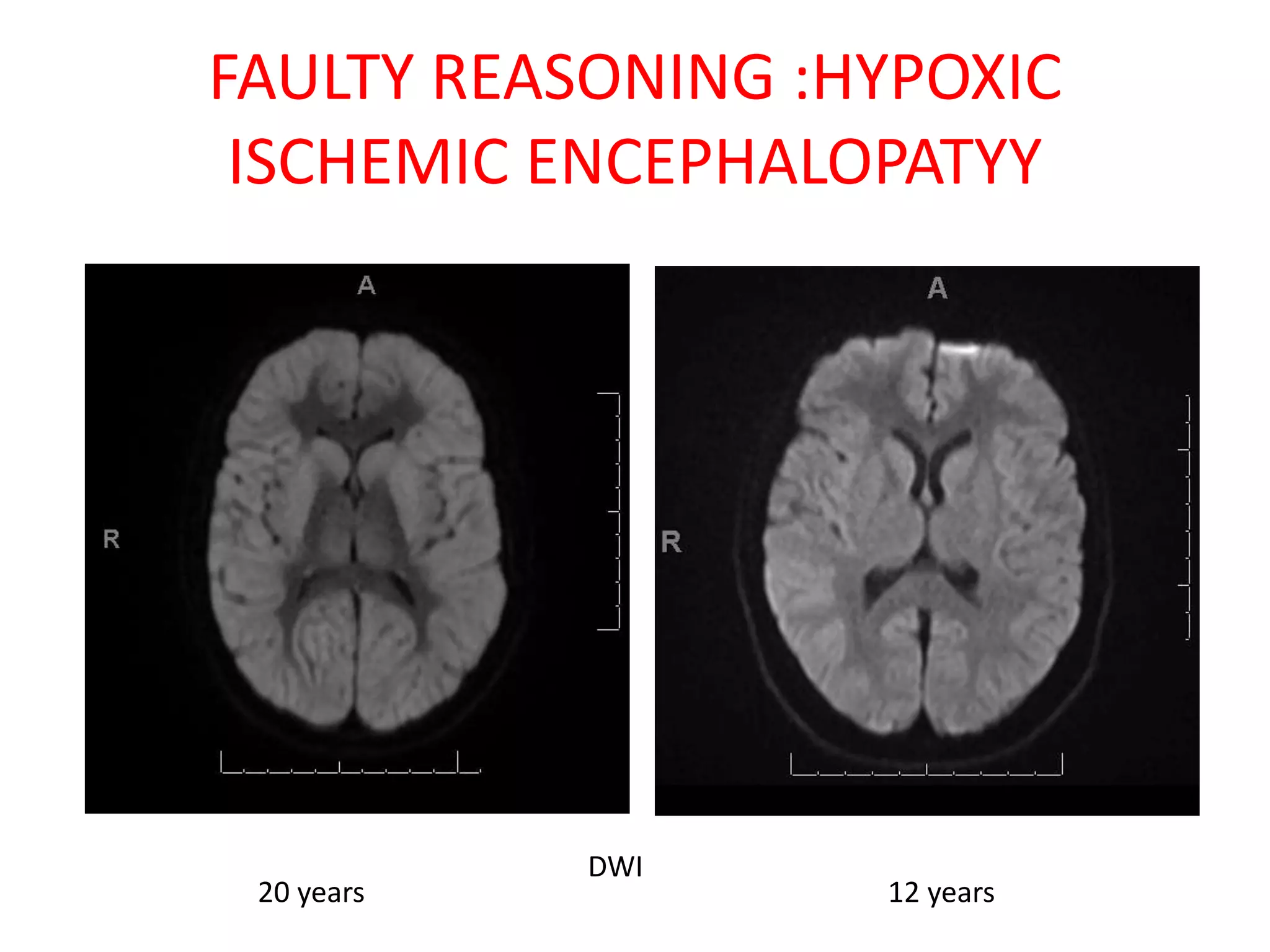 FAULTY REASONING :HYPOXIC
ISCHEMIC ENCEPHALOPATYY
20 years 12 years
DWI
 