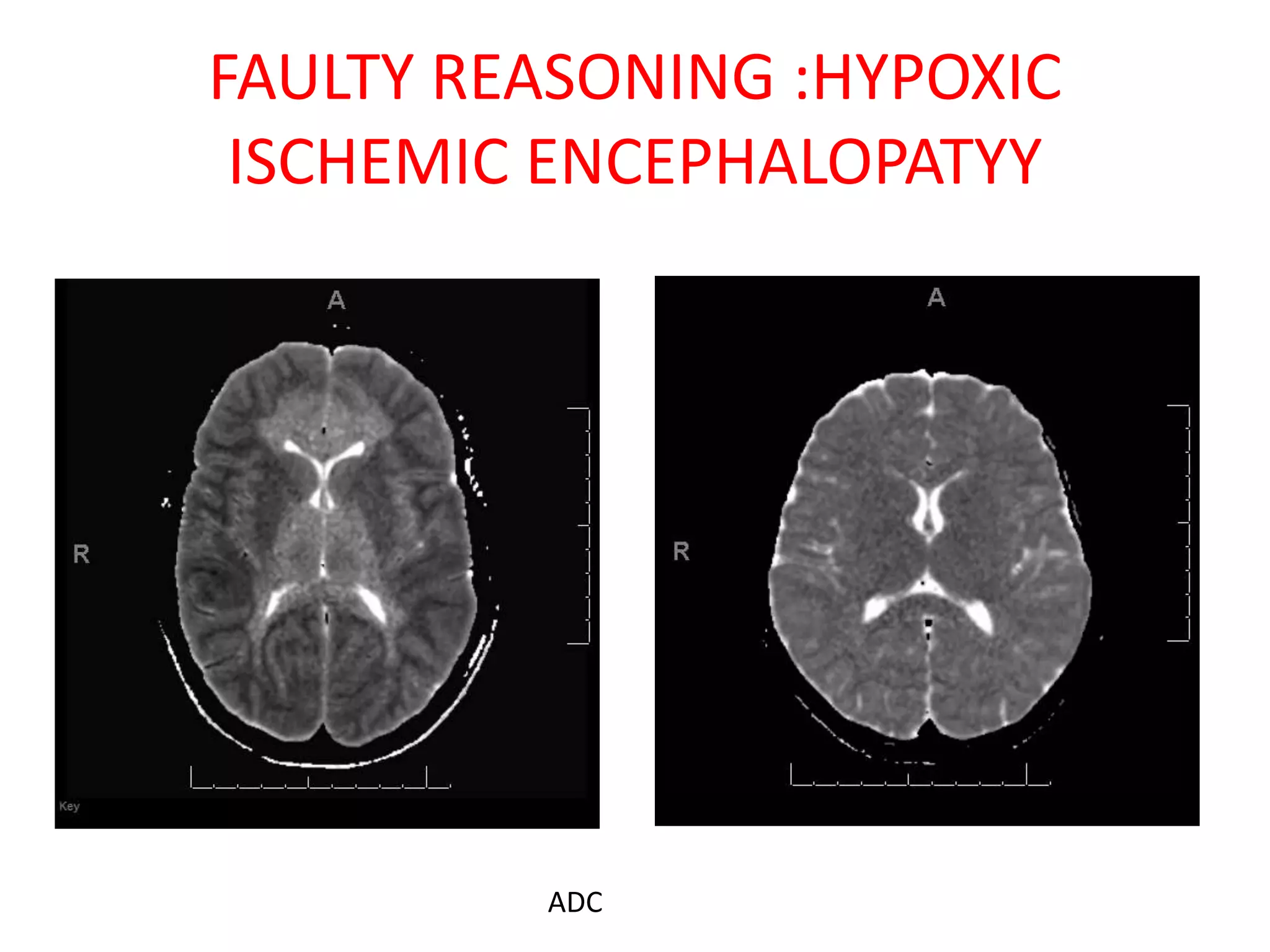 FAULTY REASONING :HYPOXIC
ISCHEMIC ENCEPHALOPATYY
ADC
 