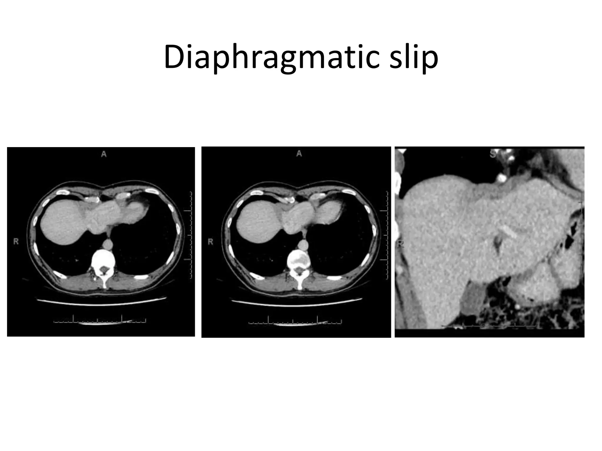 Diaphragmatic slip
 