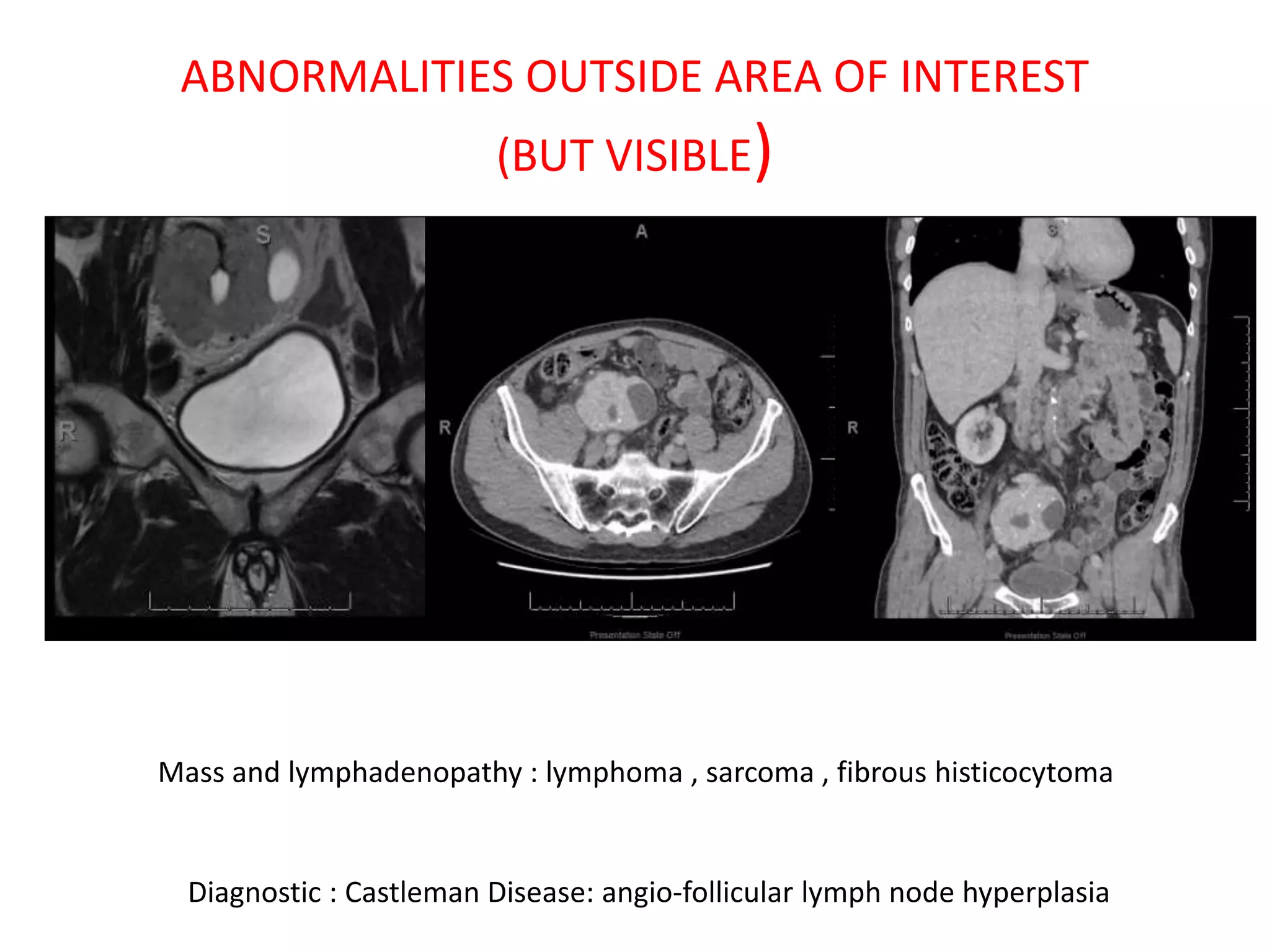 ABNORMALITIES OUTSIDE AREA OF INTEREST
(BUT VISIBLE)
Mass and lymphadenopathy : lymphoma , sarcoma , fibrous histicocytoma
Diagnostic : Castleman Disease: angio-follicular lymph node hyperplasia
 