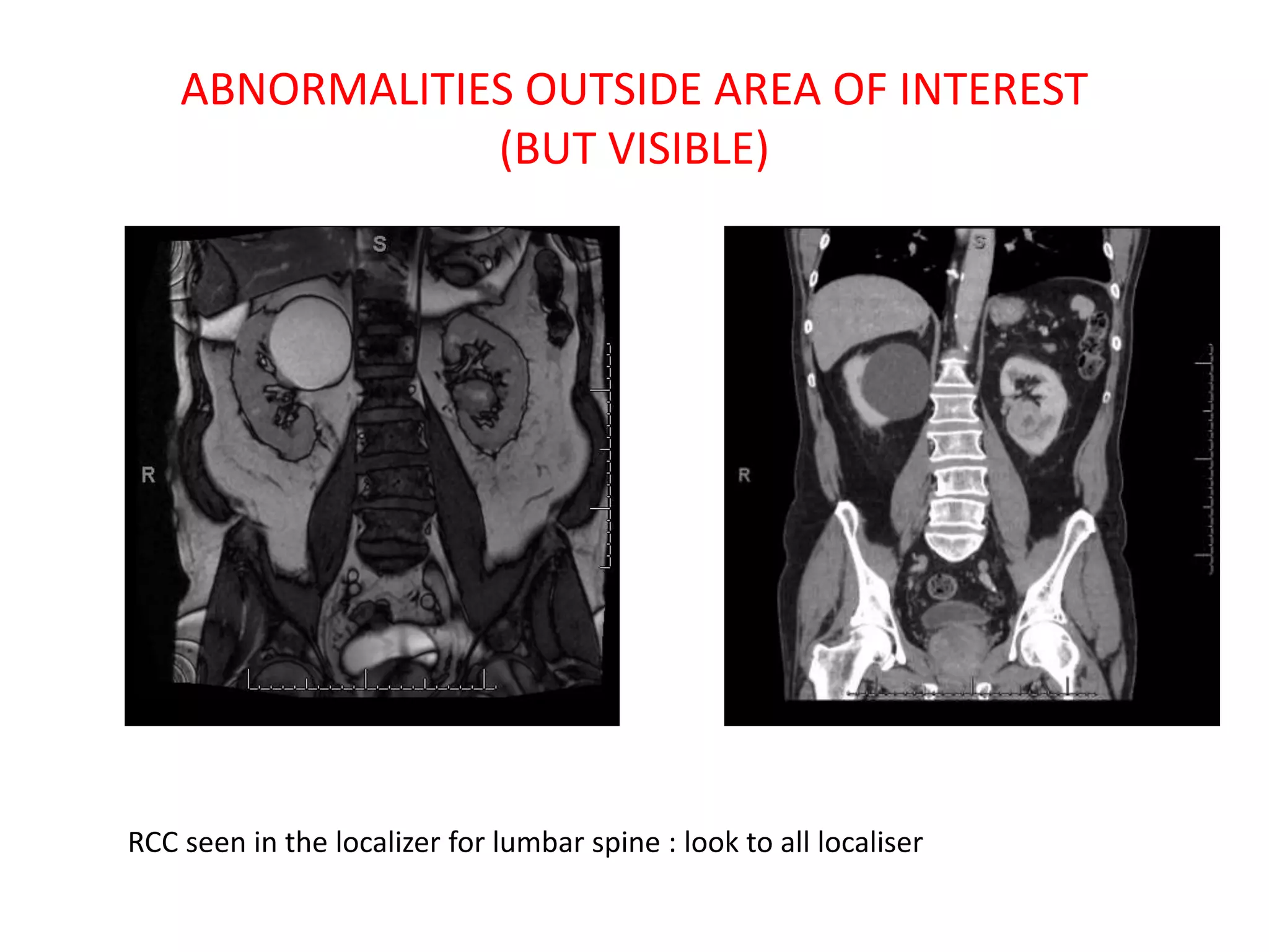 ABNORMALITIES OUTSIDE AREA OF INTEREST
(BUT VISIBLE)
RCC seen in the localizer for lumbar spine : look to all localiser
 