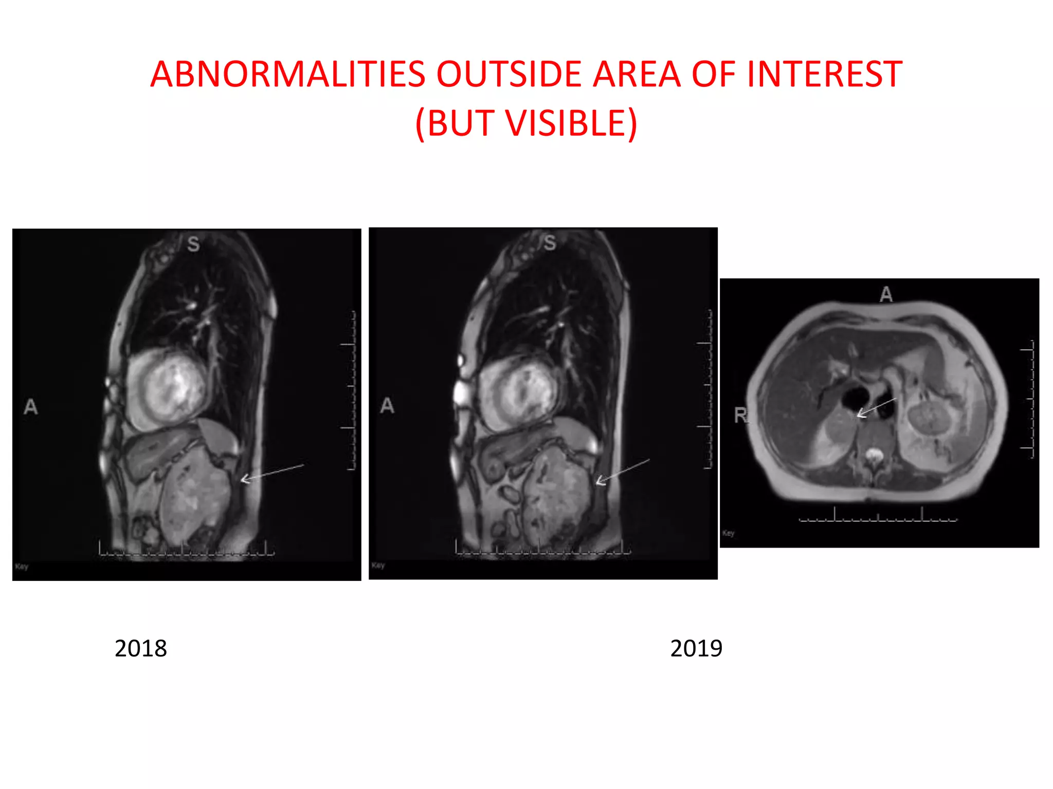 ABNORMALITIES OUTSIDE AREA OF INTEREST
(BUT VISIBLE)
2018 2019
 