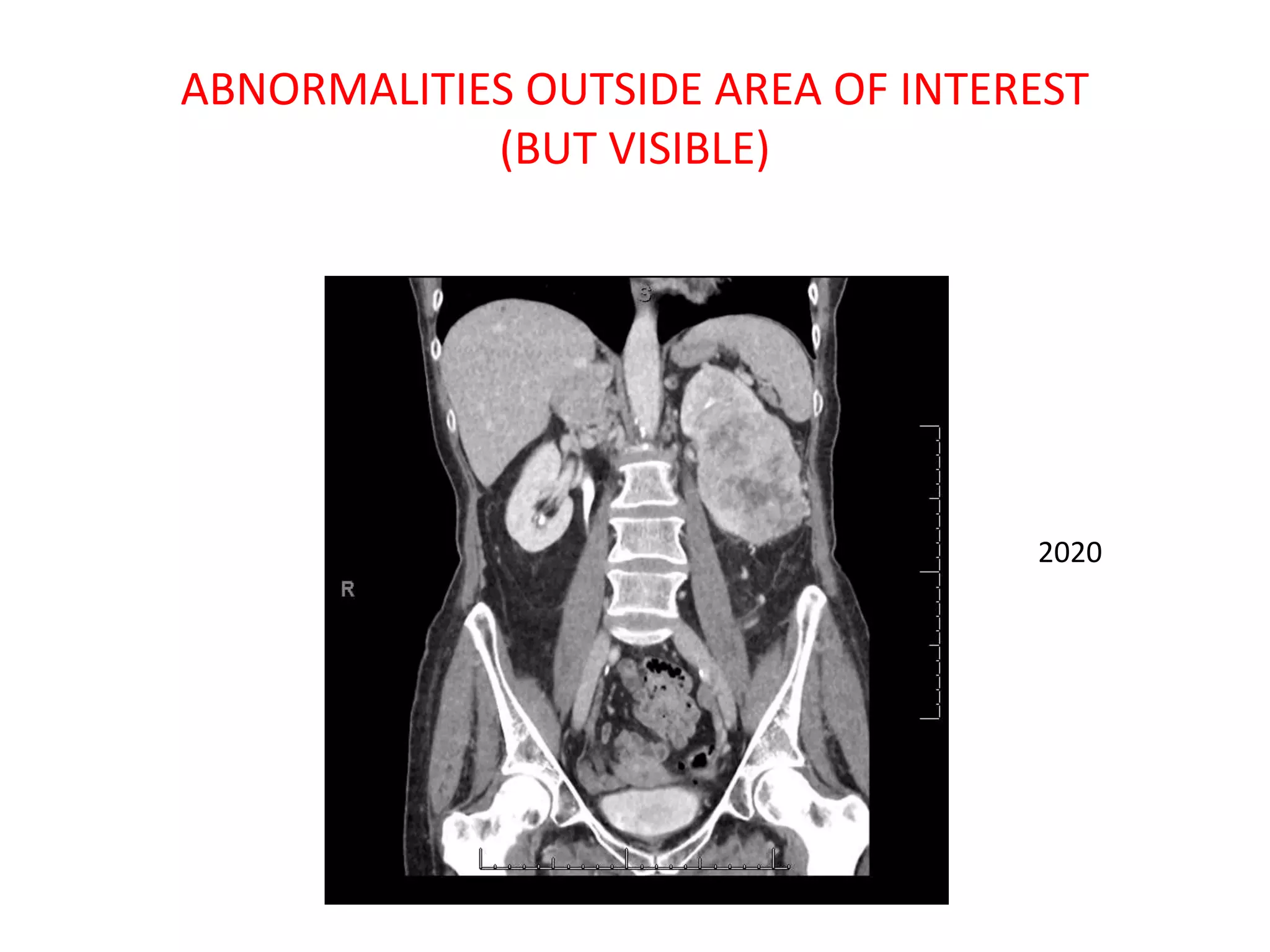 ABNORMALITIES OUTSIDE AREA OF INTEREST
(BUT VISIBLE)
2020
 