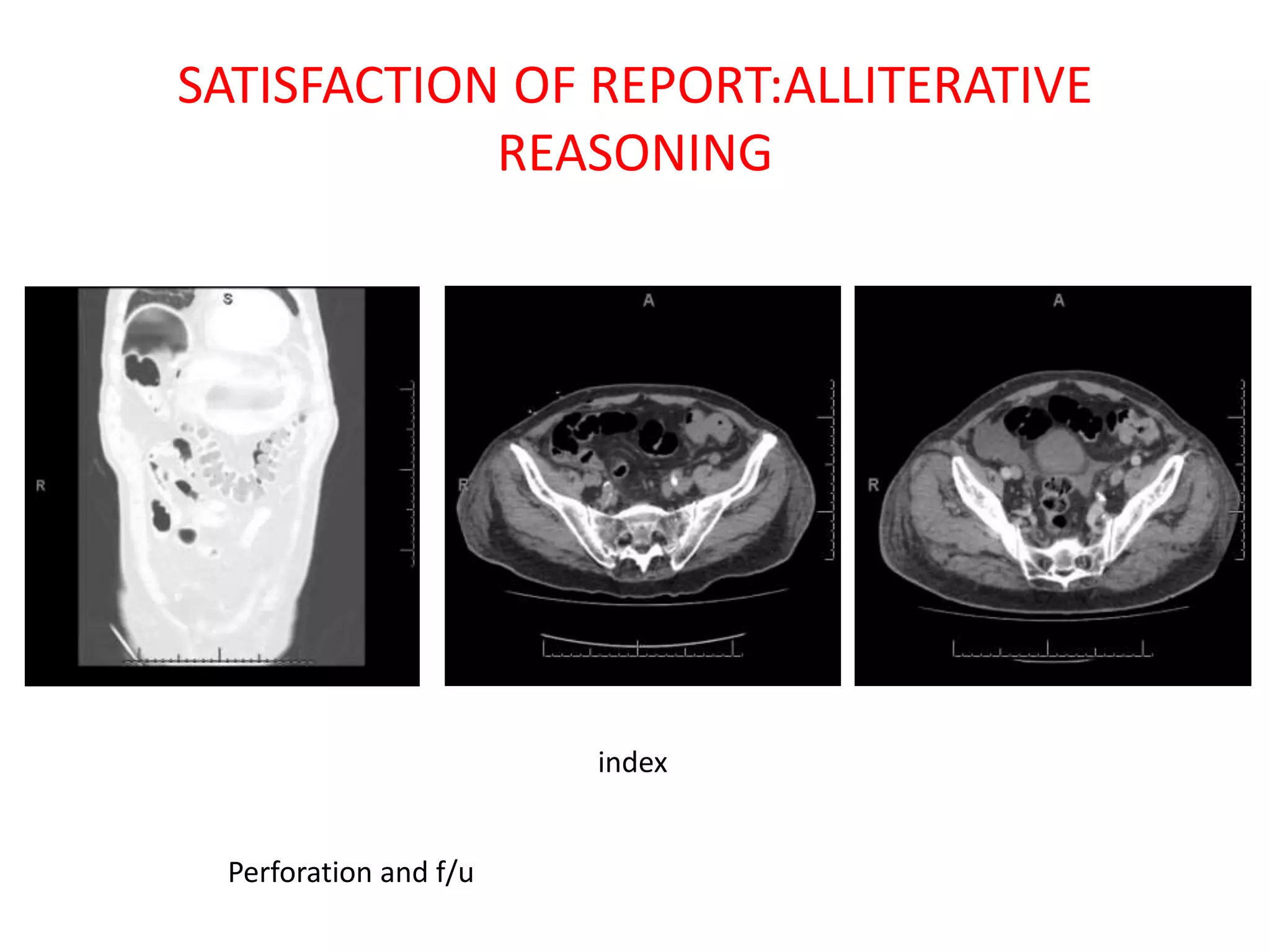 SATISFACTION OF REPORT:ALLITERATIVE
REASONING
index
Perforation and f/u
 