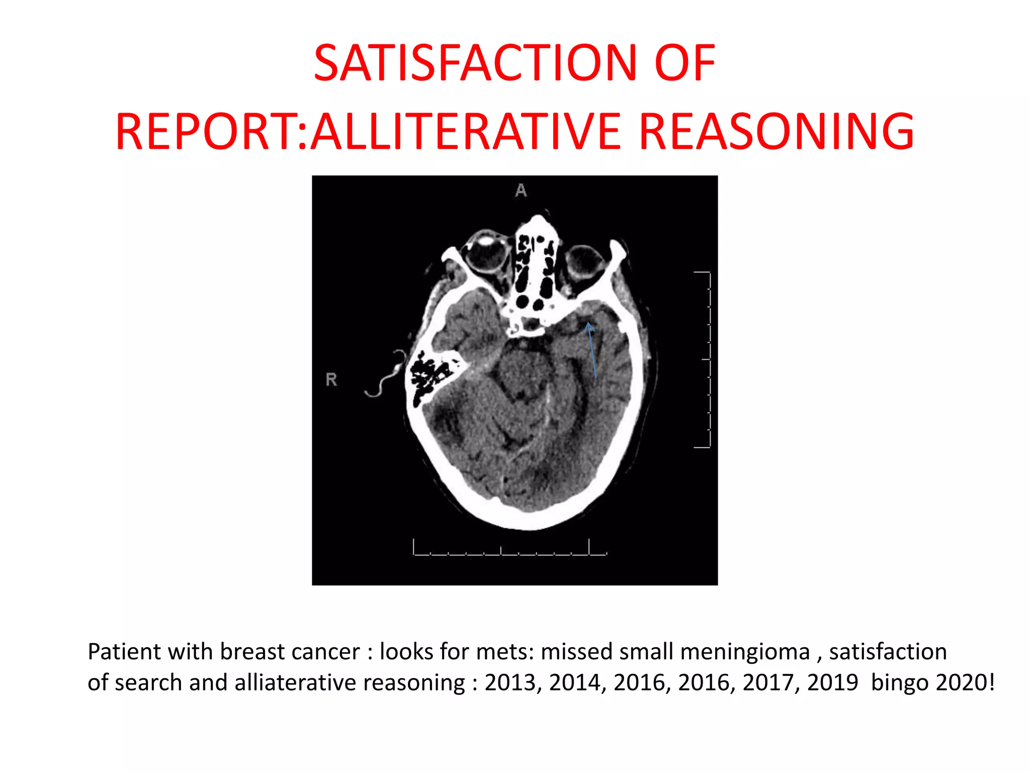 SATISFACTION OF
REPORT:ALLITERATIVE REASONING
Patient with breast cancer : looks for mets: missed small meningioma , satisfaction
of search and alliaterative reasoning : 2013, 2014, 2016, 2016, 2017, 2019 bingo 2020!
 