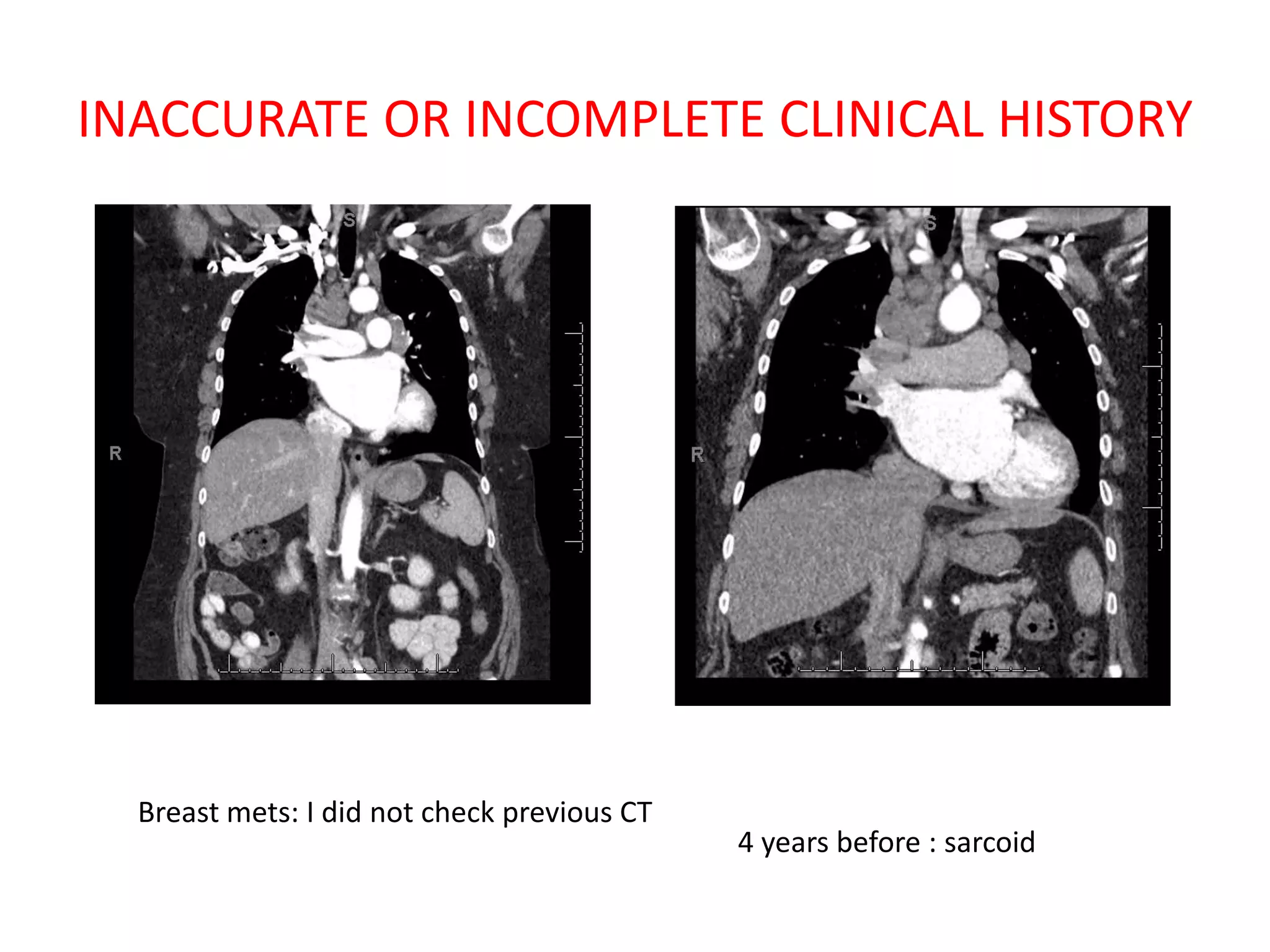 INACCURATE OR INCOMPLETE CLINICAL HISTORY
Breast mets: I did not check previous CT
4 years before : sarcoid
 