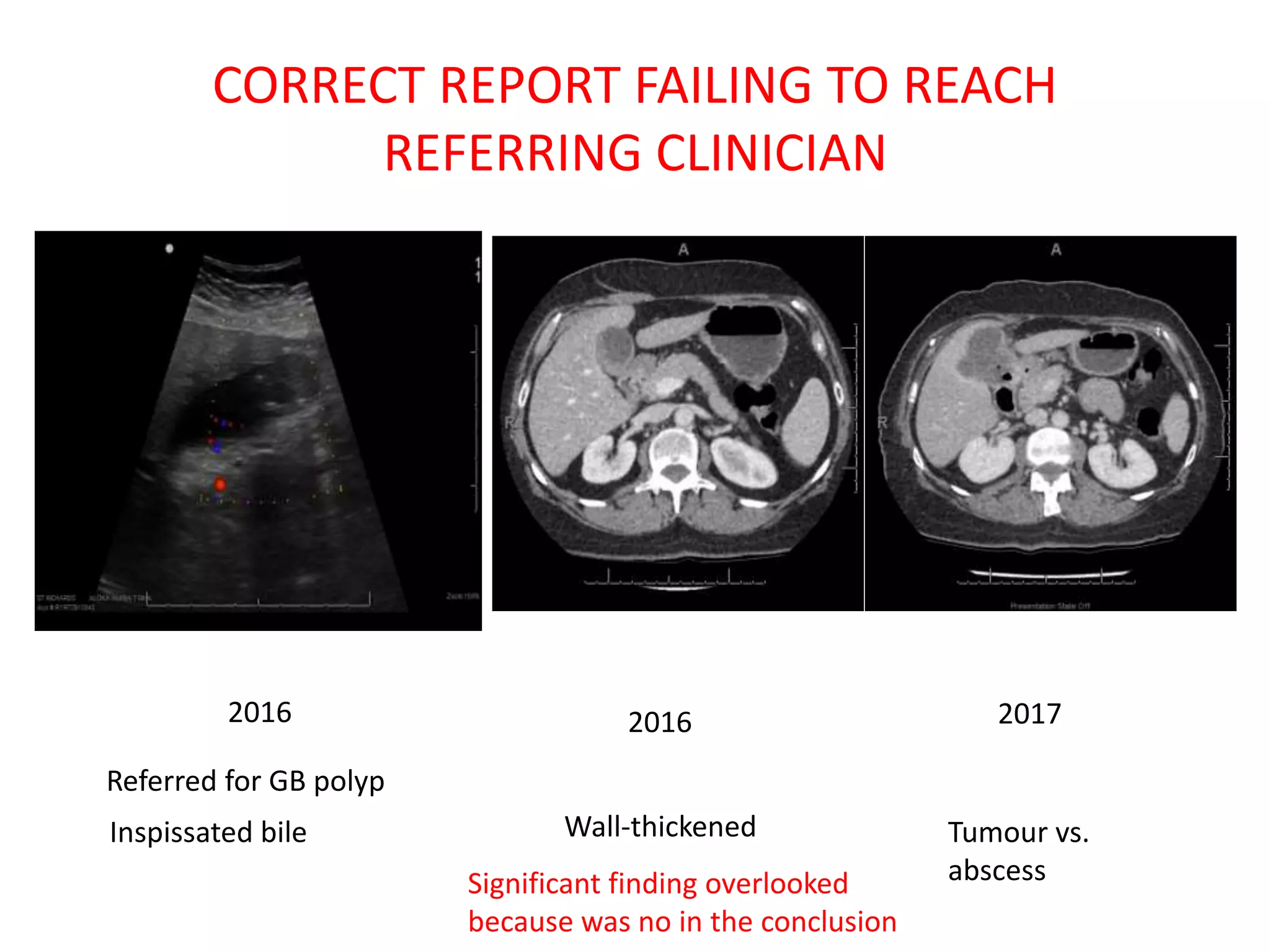 CORRECT REPORT FAILING TO REACH
REFERRING CLINICIAN
2016 2016 2017
Inspissated bile Wall-thickened Tumour vs.
abscess
Significant finding overlooked
because was no in the conclusion
Referred for GB polyp
 