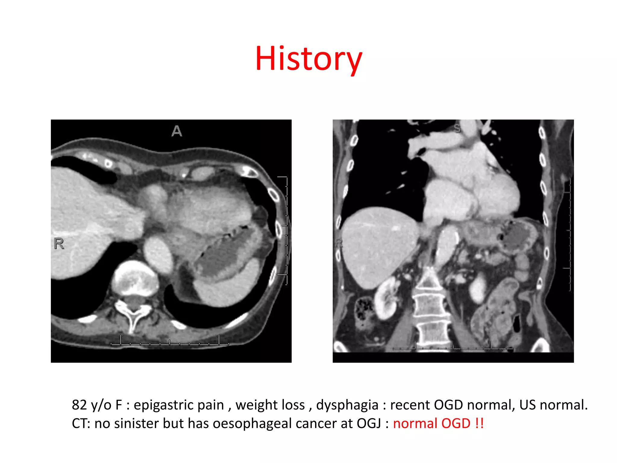 History
82 y/o F : epigastric pain , weight loss , dysphagia : recent OGD normal, US normal.
CT: no sinister but has oesophageal cancer at OGJ : normal OGD !!
 