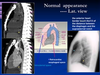 Normal  appearance   ----   Lat. view /231 <ul><ul><li>Retrocardiac </li></ul></ul><ul><ul><li>esophageal space </li></ul>...