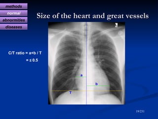 Size of the heart and great vessels /231 a b C/T ratio = a+b / T =  ≤  0.5 T methods normal abnormities diseases 