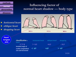 Influencing factor of    normal heart shadow --- body type <ul><li>horizontal heart </li></ul><ul><li>oblique heart </li><...